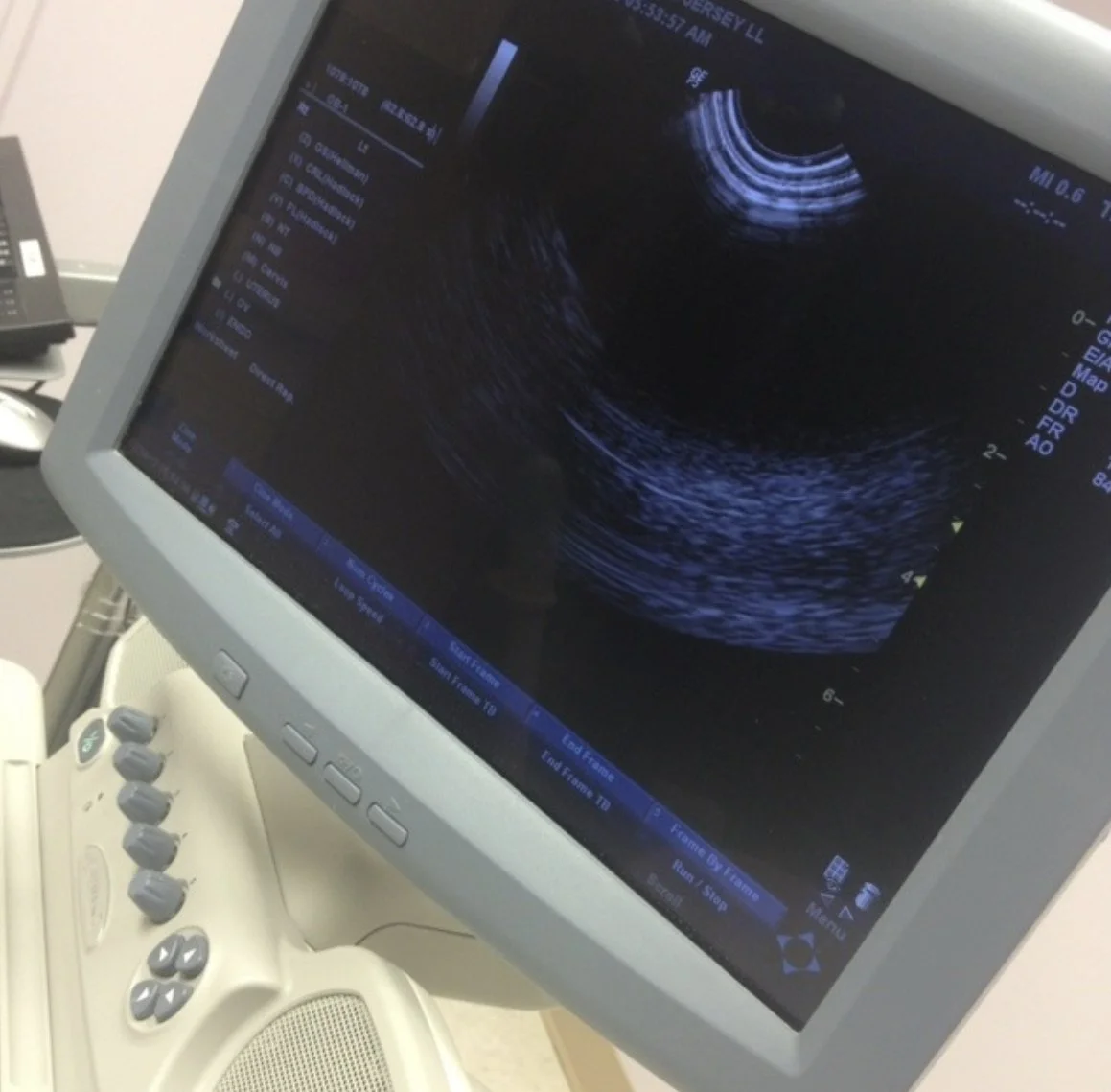 Ultrasound medical image displayed on a monitor, showing a black and white sonogram of an internal organ or tissue.