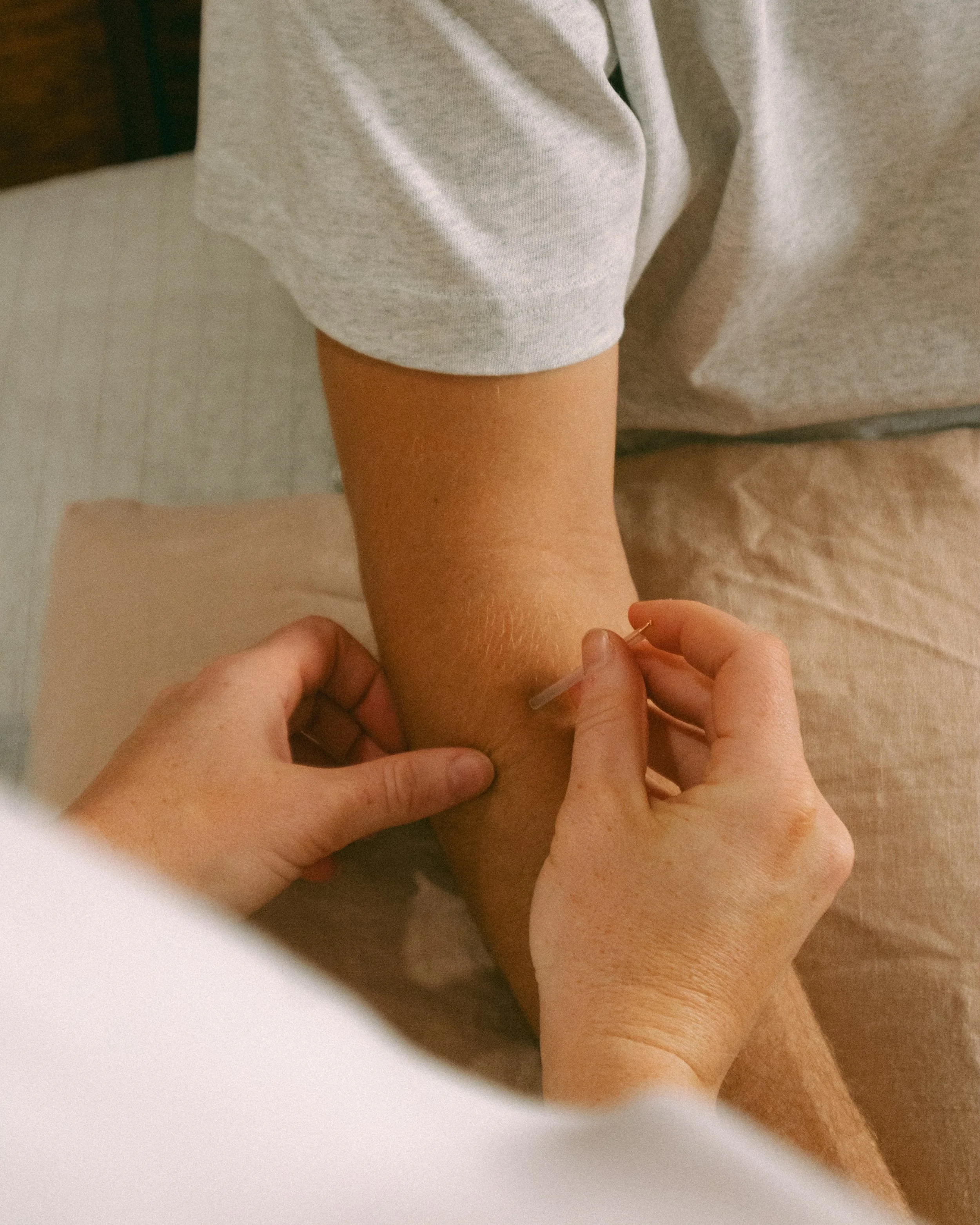 Sunny Side Physio - Dry Needling