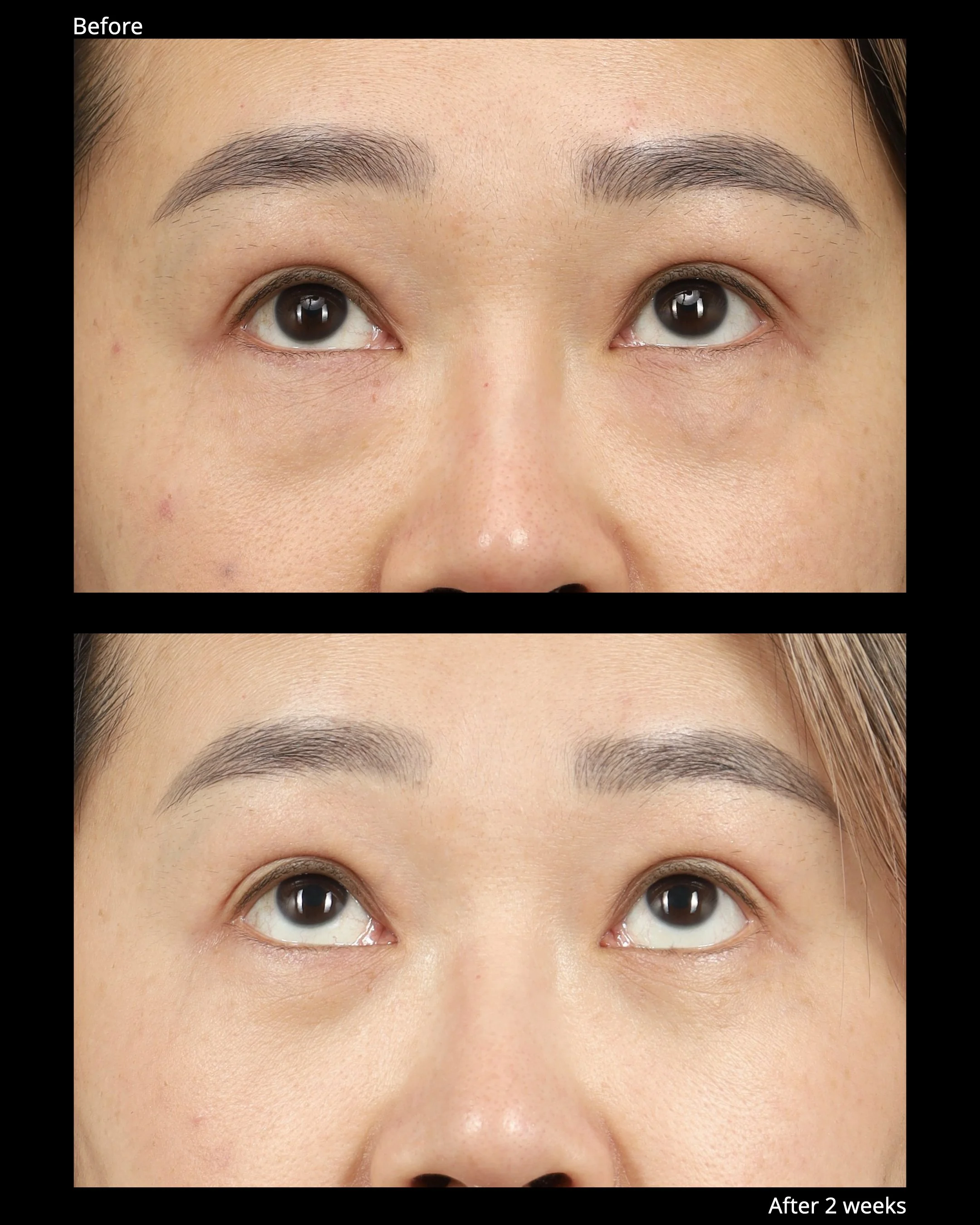 Before and after transconjunctival lower blepharoplasty with for under-eye bags.