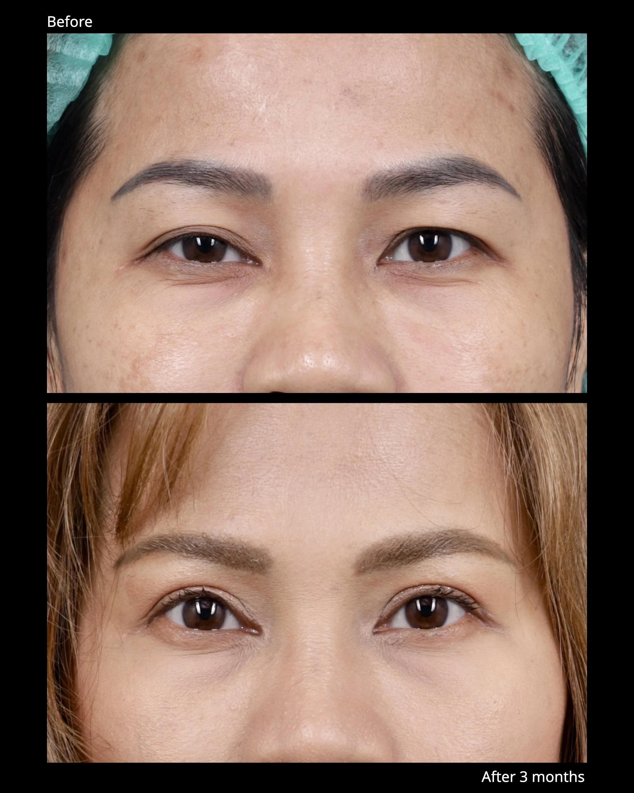 Before and after levator advancement for upper eyelid ptosis, demonstrating improved eyelid elevation and symmetry.