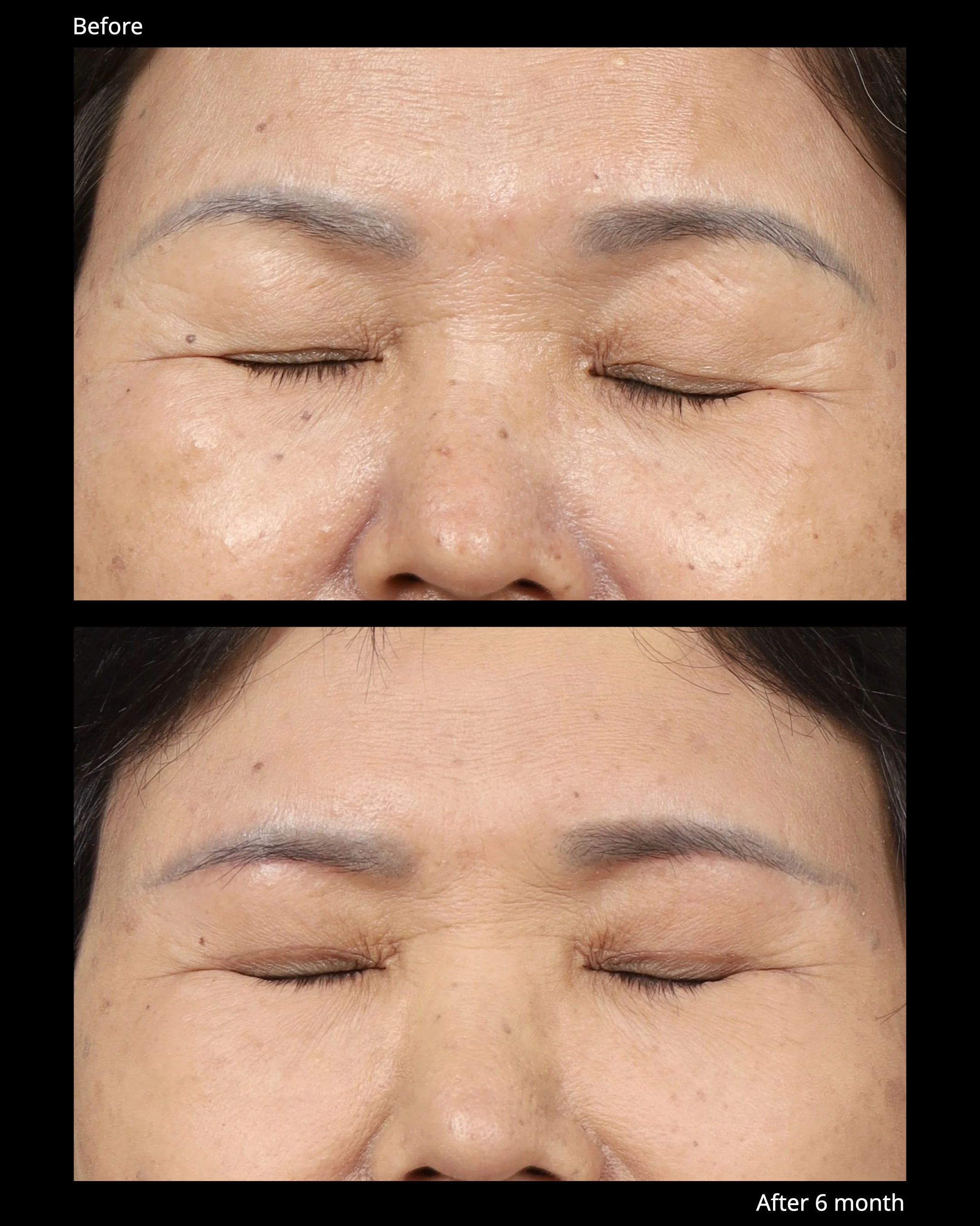 Sub Brow Lift Before and After