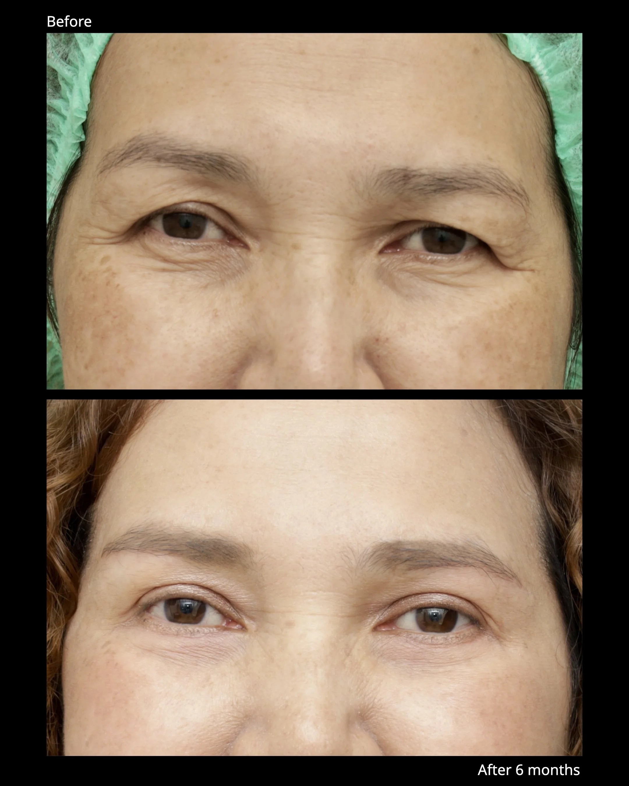 Sub Brow Lift Before and After