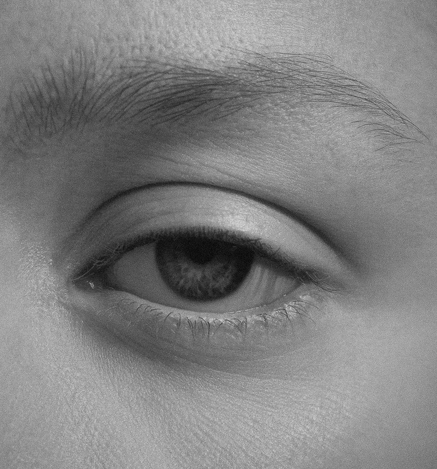 Why Ptosis Correction Is Essential for Function and Aesthetics