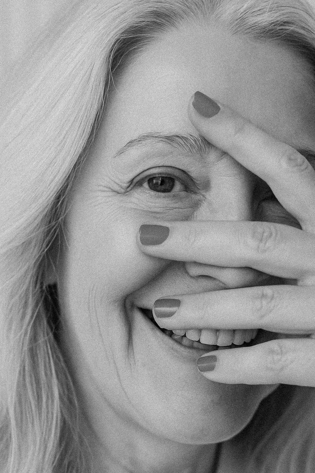 Why a Sub-Brow Lift May Be Superior to Blepharoplasty for Sagging Eyelids?