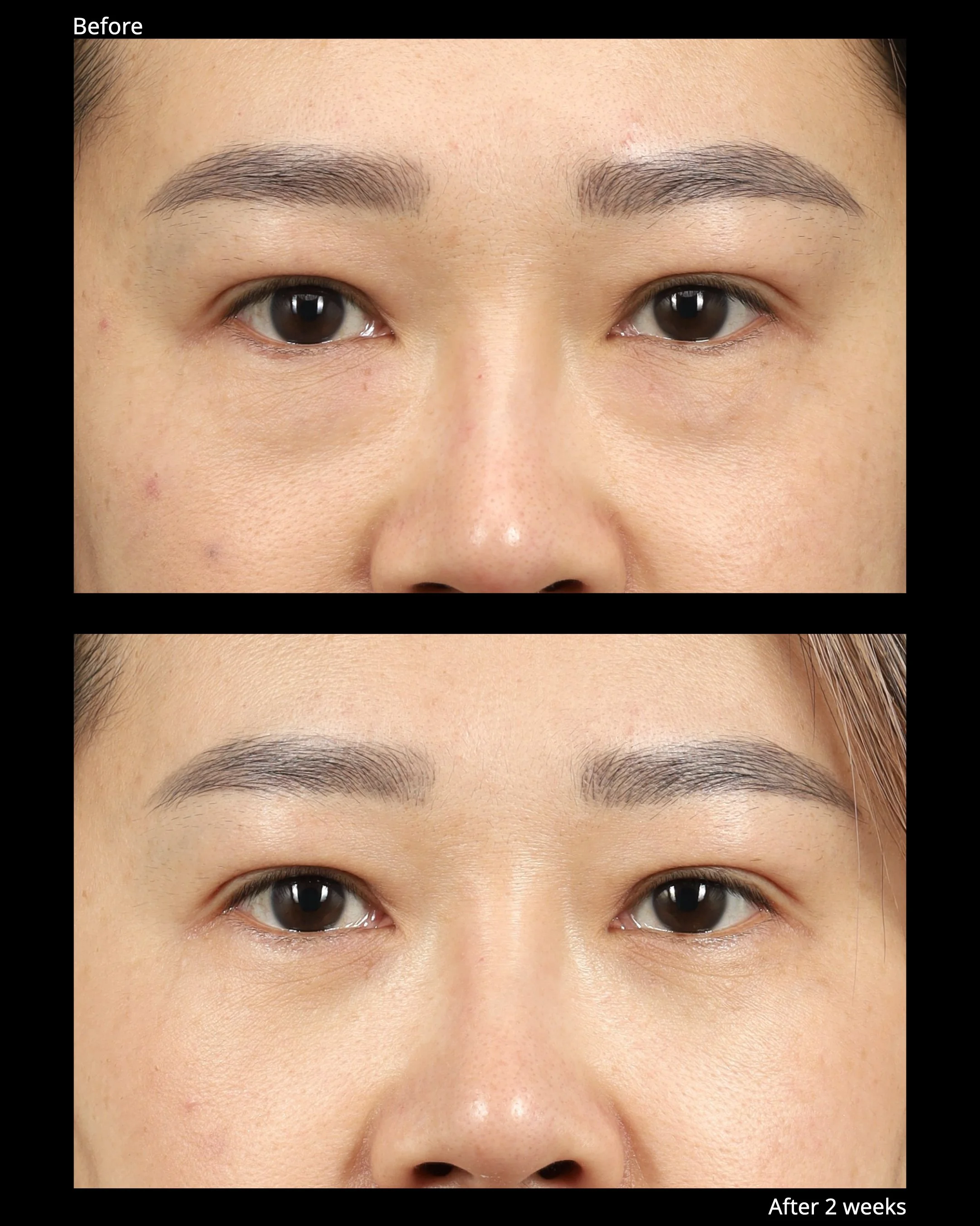 Before and after transconjunctival lower blepharoplasty with for under-eye bags.