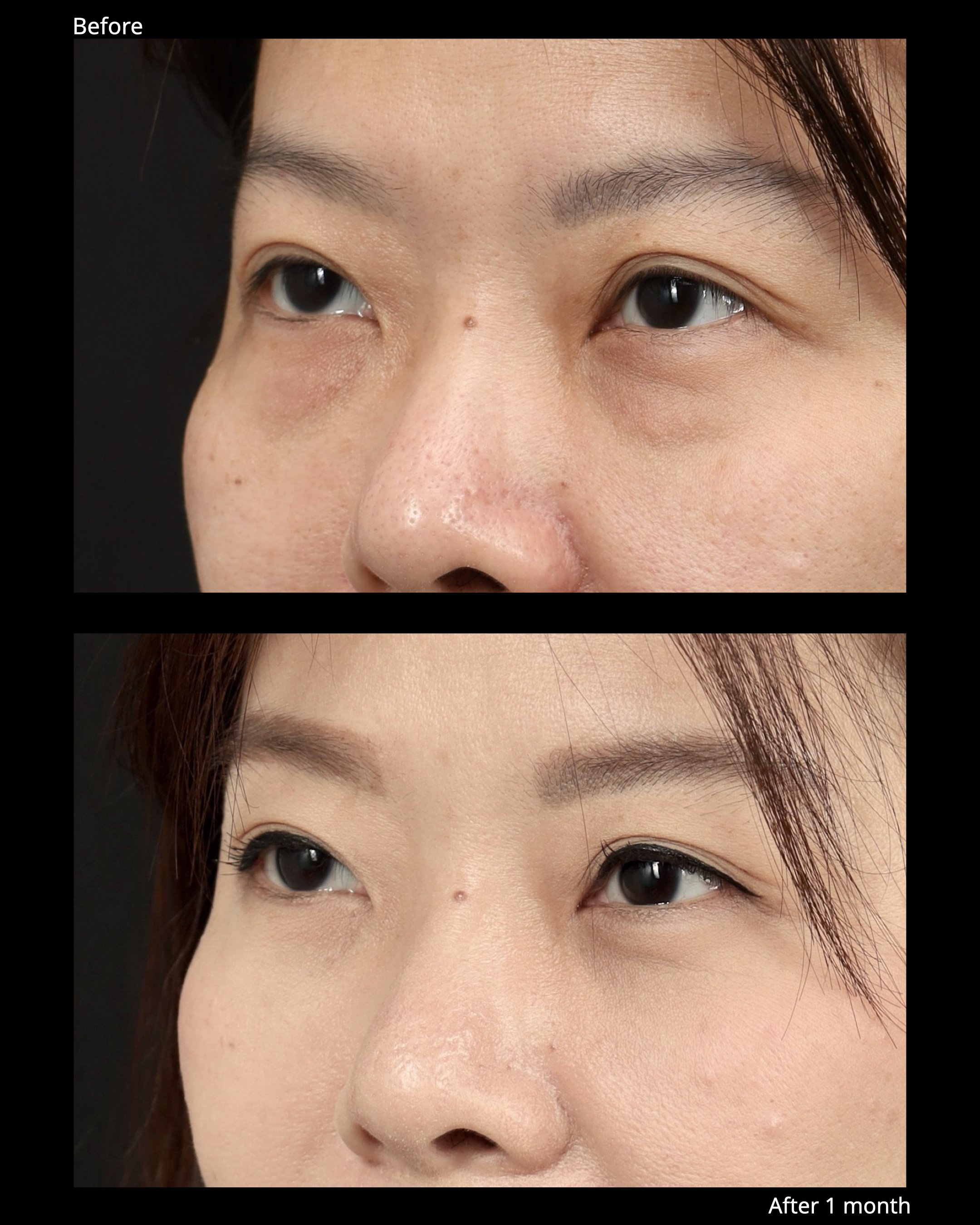 Before and after transconjunctival lower blepharoplasty with for under-eye bags.