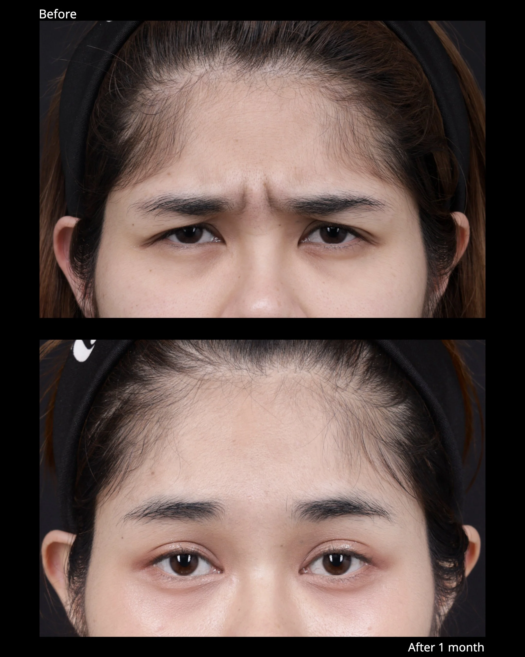 Image 2 Endoscopic brow lift before and after result with natural brow elevation and softer forehead expression.
