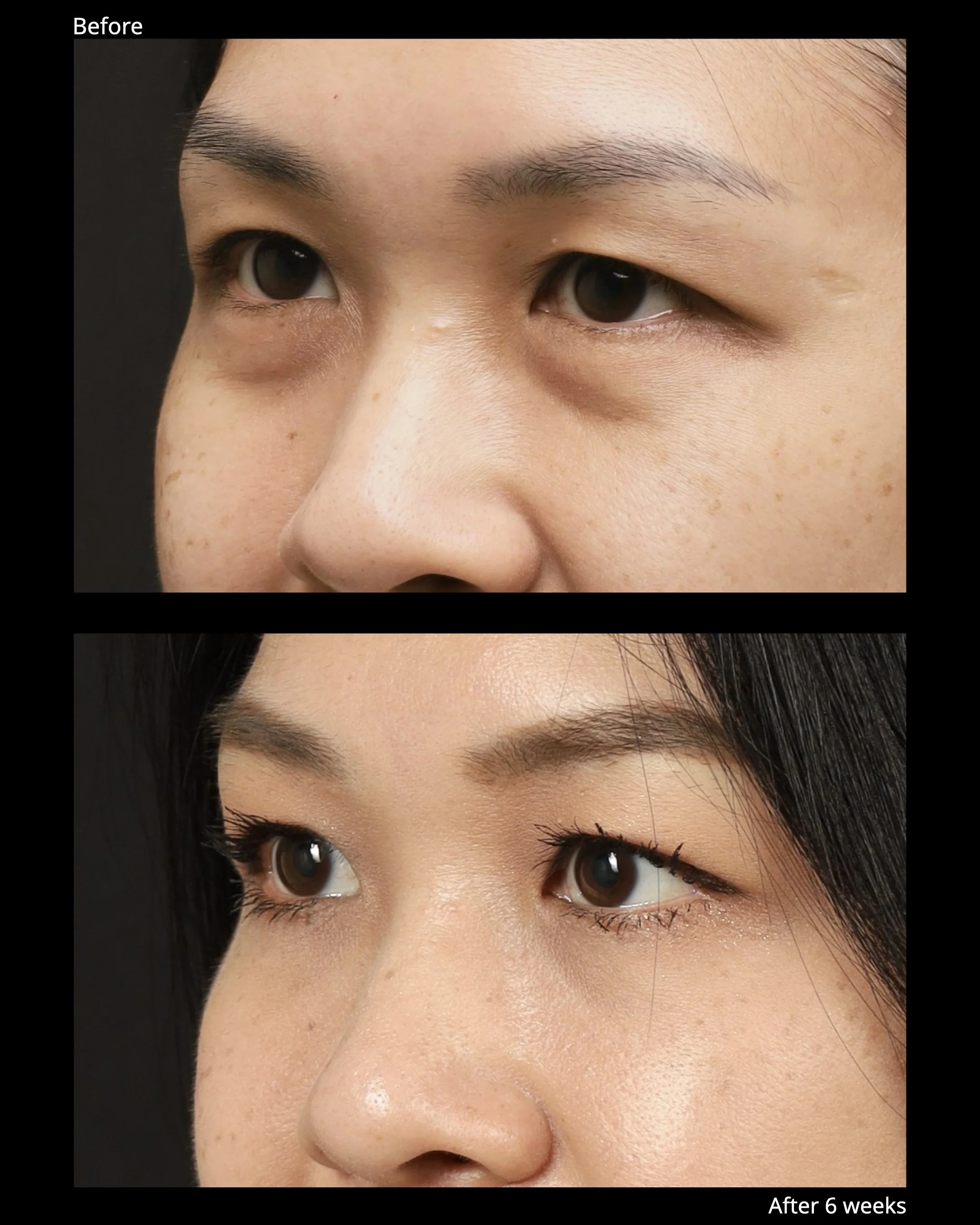 Before and after lower eyelid rejuvenation showing improvement of under-eye bags and tear trough shadow.
