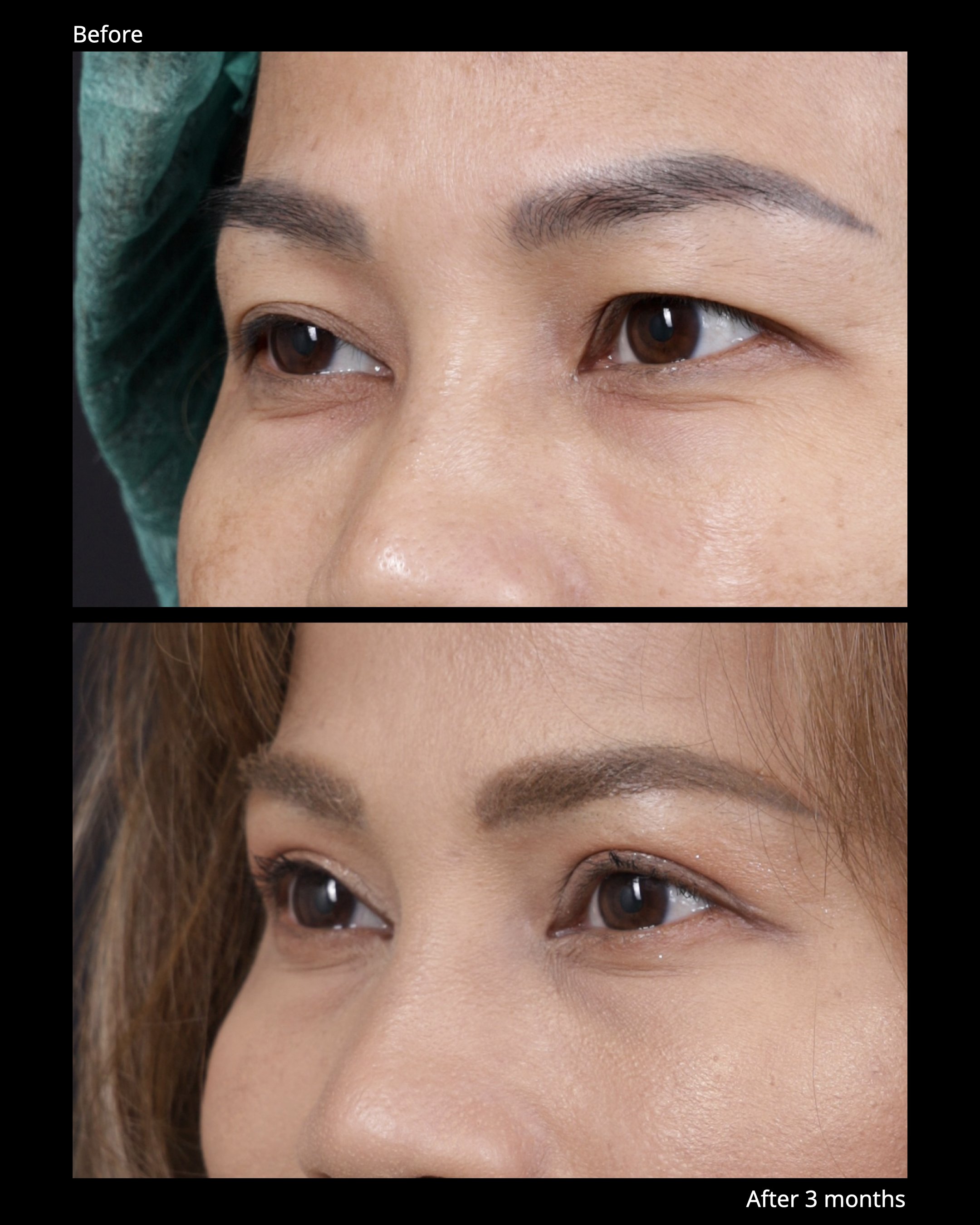 Before and after levator advancement for upper eyelid ptosis, demonstrating improved eyelid elevation and symmetry.