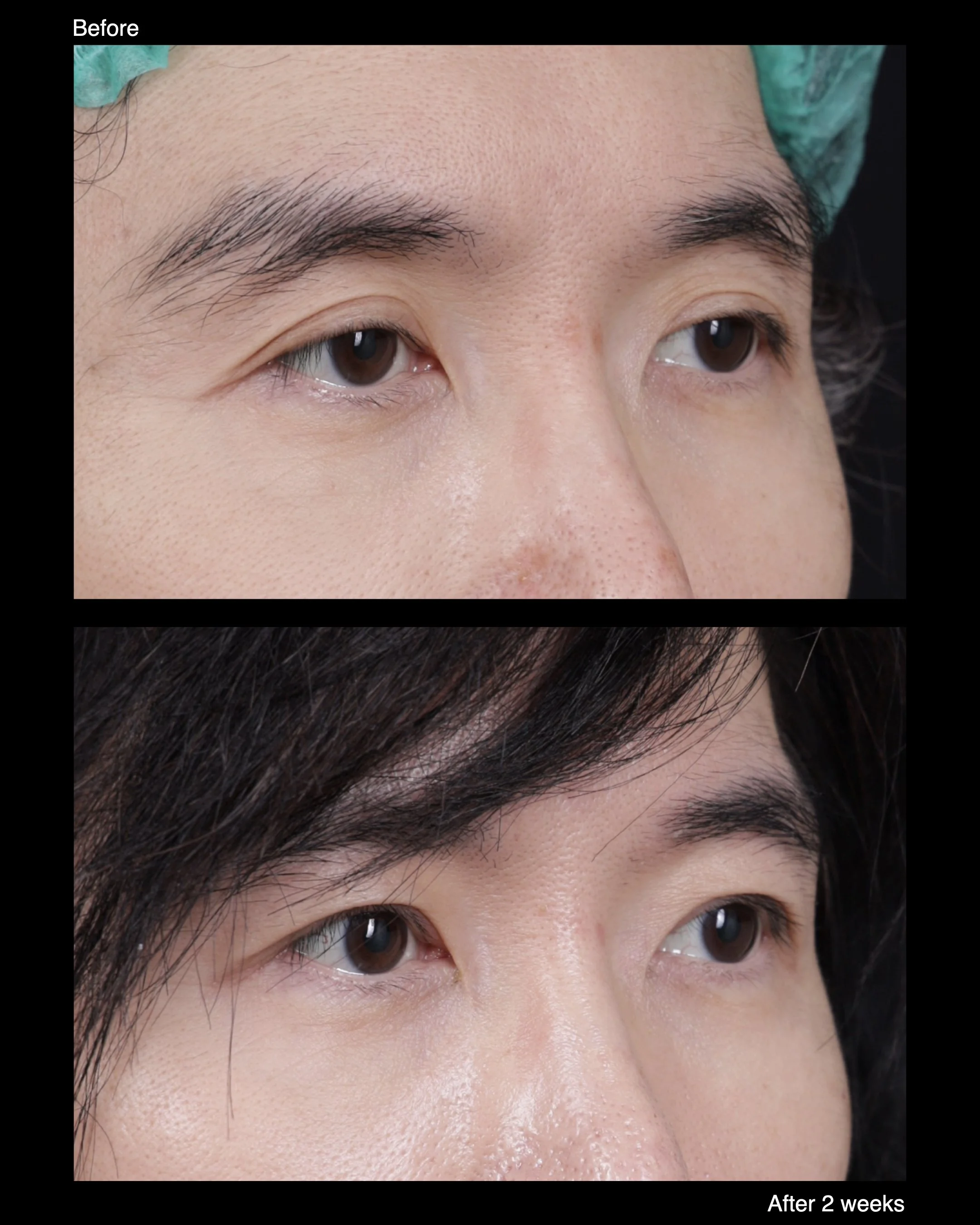 Before and after ptosis correction with levator advancement, showing improved upper eyelid height and more balanced eye opening.