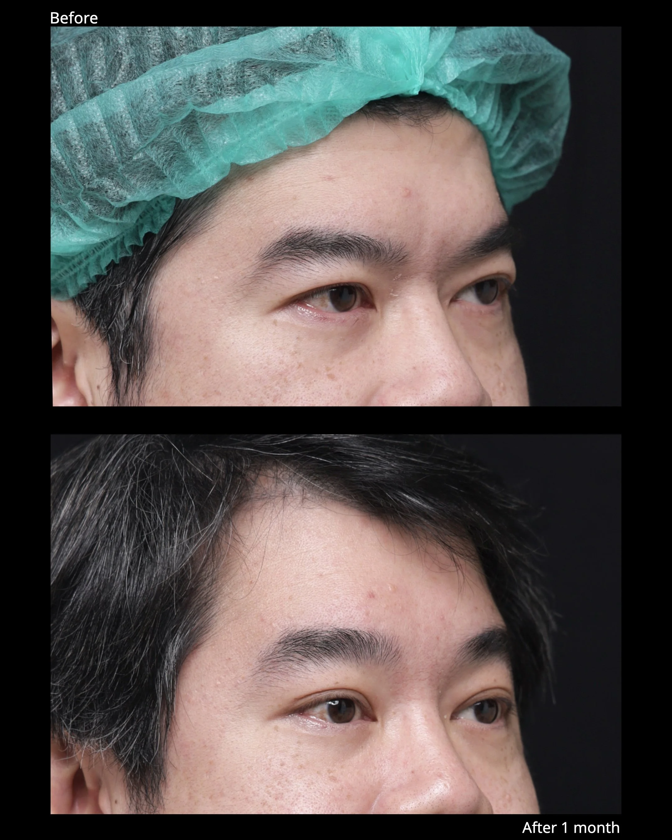 Before and after endoscopic brow lift showing improved eyebrow position and brighter upper eyelid appearance.