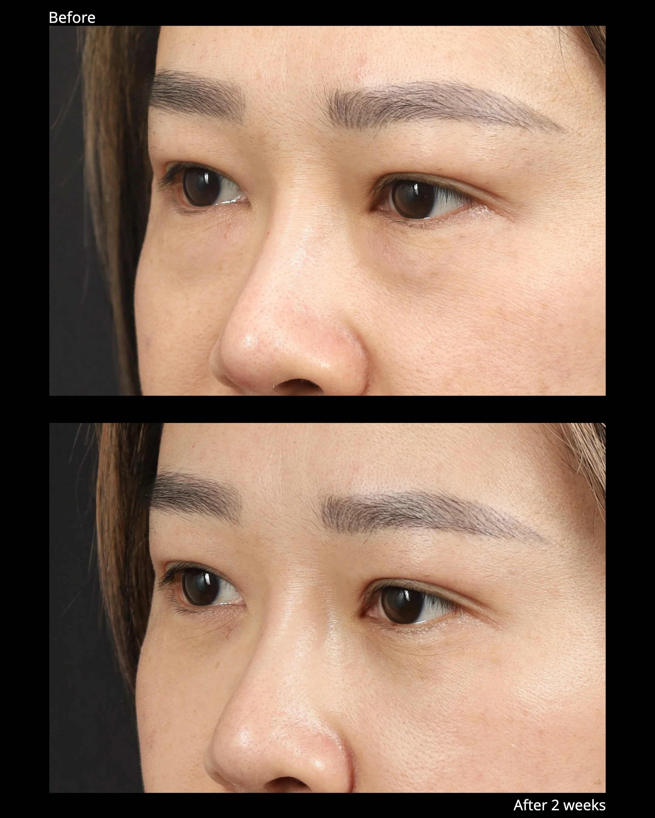 Before and after transconjunctival lower blepharoplasty with for under-eye bags.