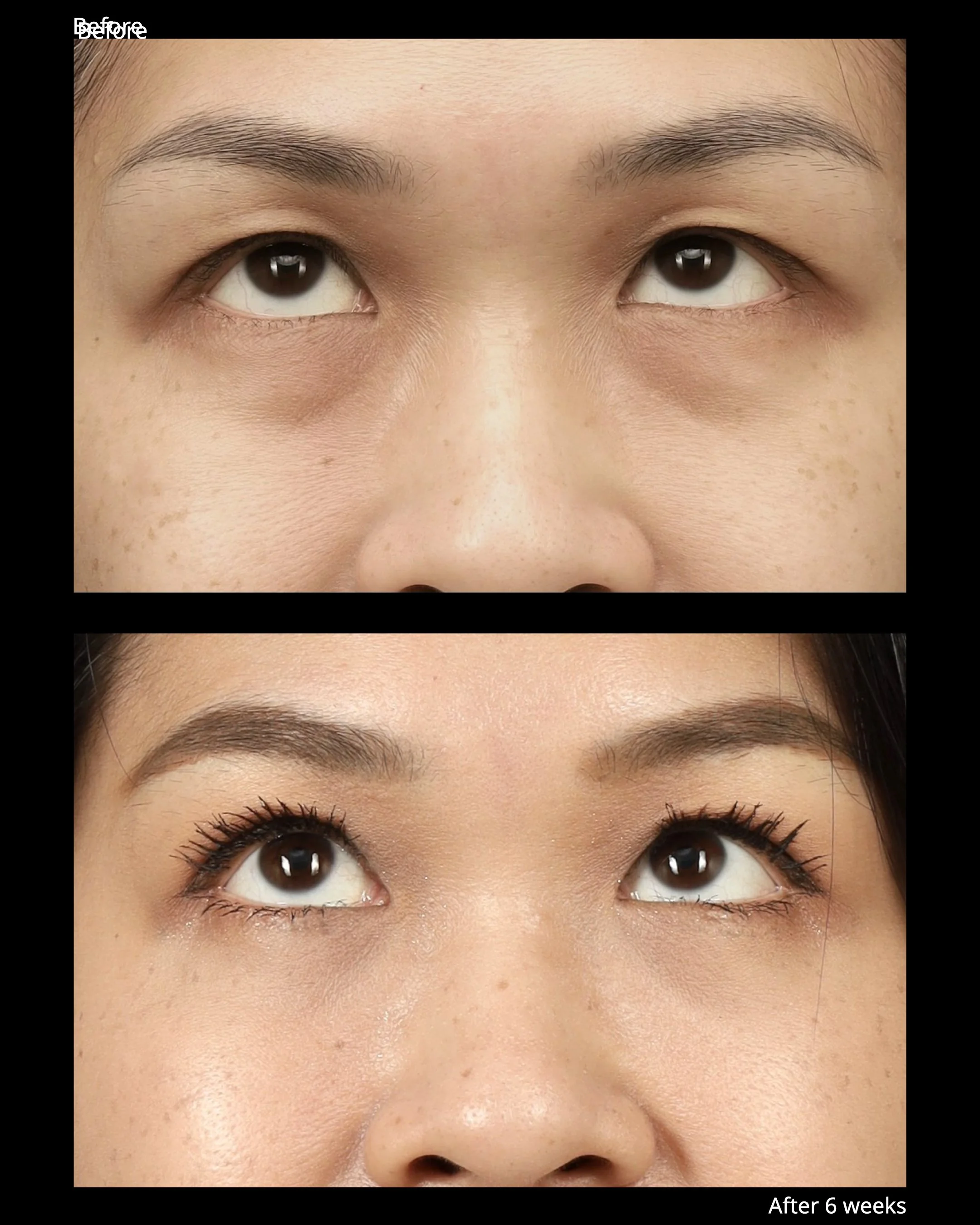 Before and after lower eyelid rejuvenation showing improvement of under-eye bags and tear trough shadow.