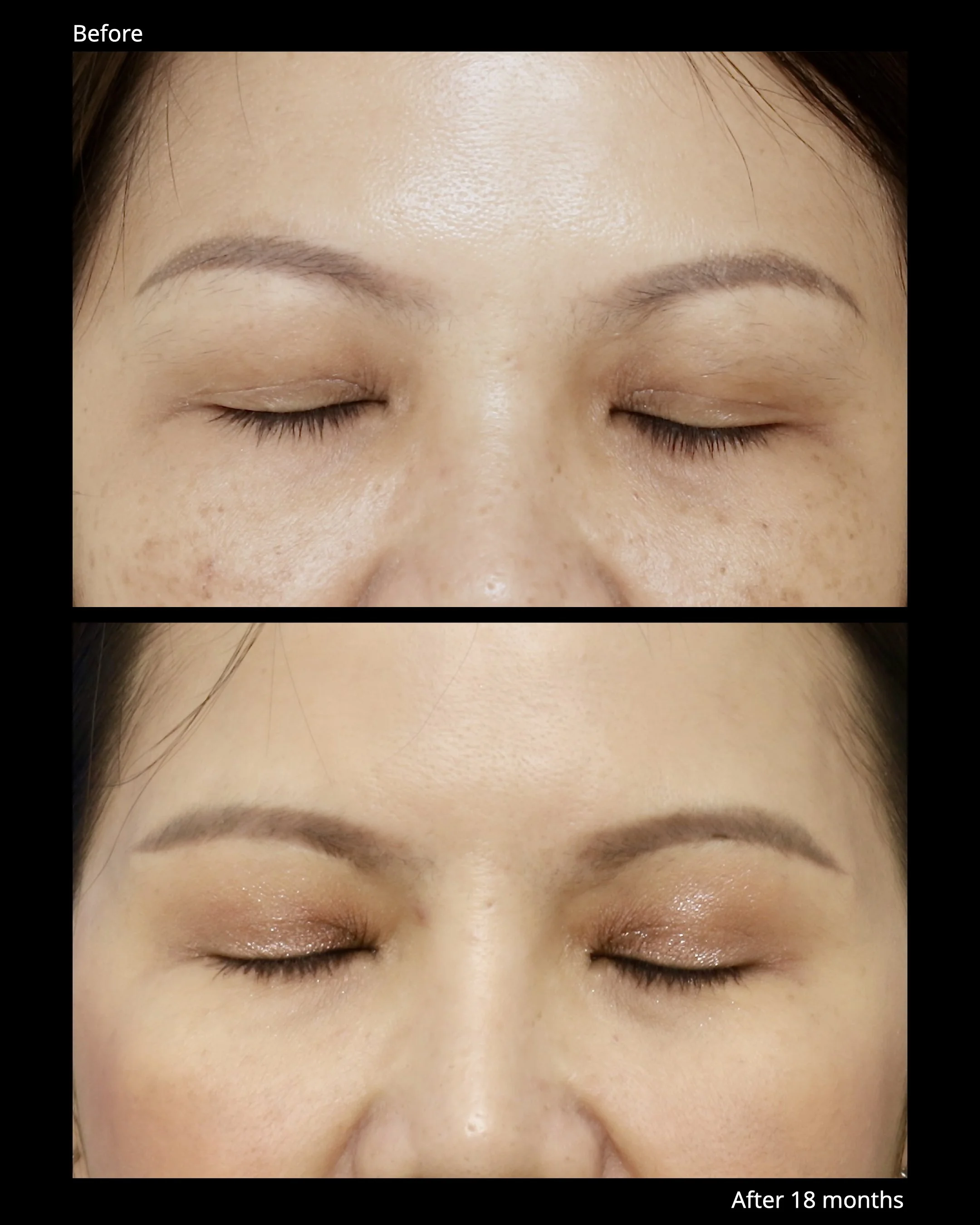 Sub Brow Lift Before and After