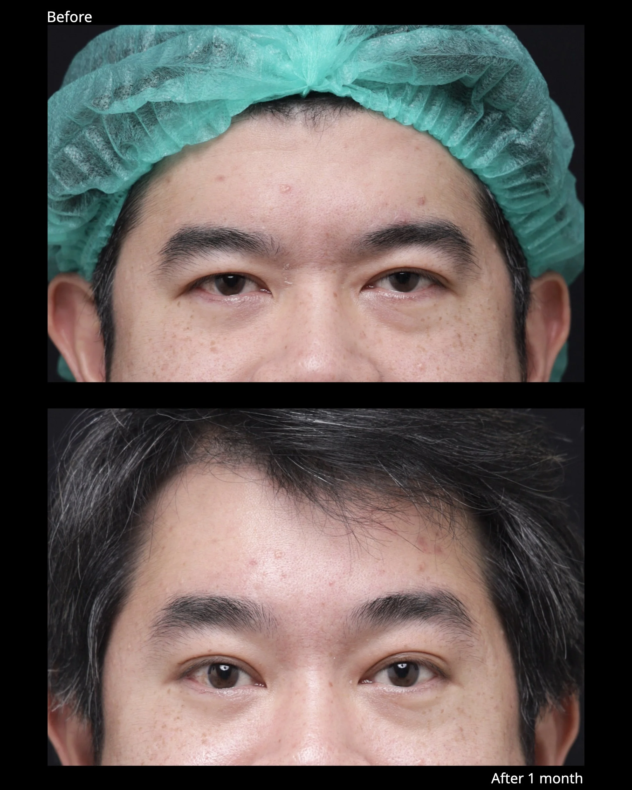 Before and after endoscopic brow lift showing improved eyebrow position and brighter upper eyelid appearance.