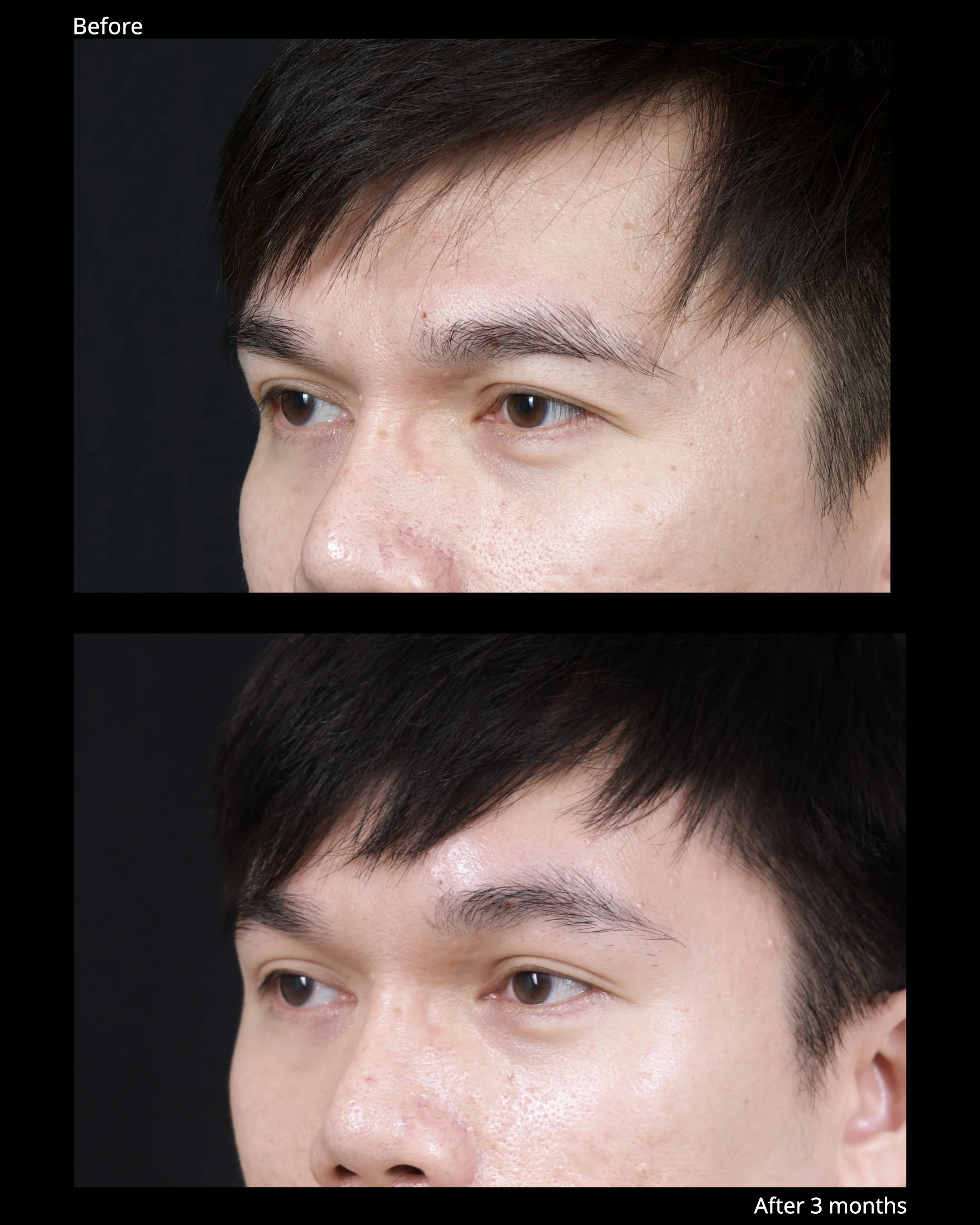 Before and after endoscopic brow lift showing improved eyebrow position and brighter upper eyelid appearance.
