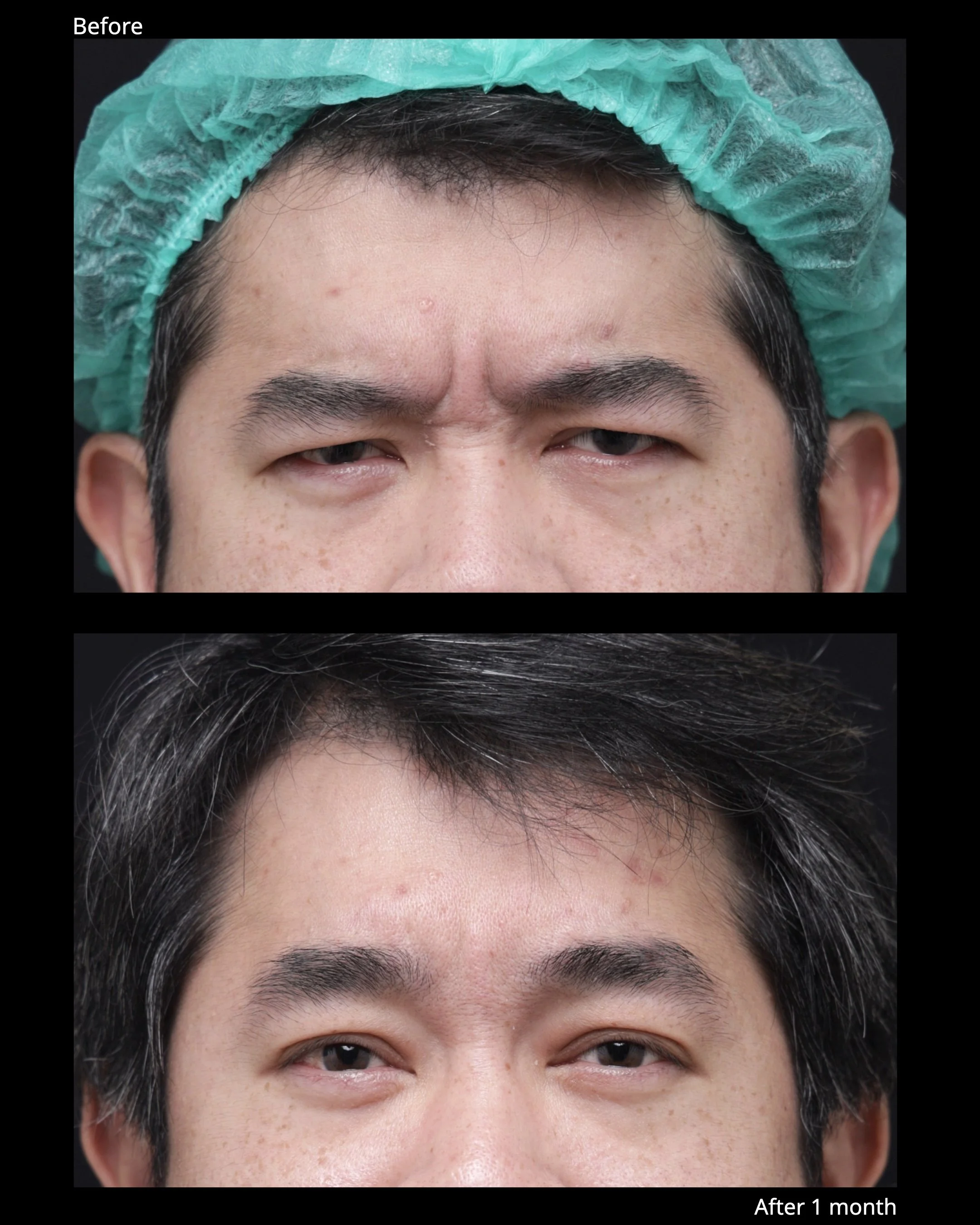 Before and after endoscopic brow lift showing improved eyebrow position and brighter upper eyelid appearance.