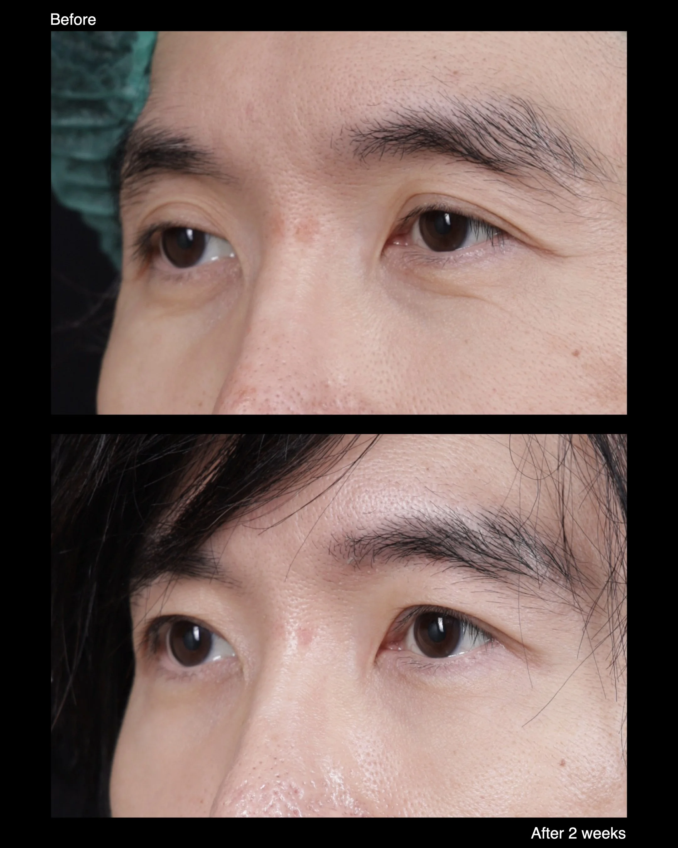 Before and after ptosis correction with levator advancement, showing improved upper eyelid height and more balanced eye opening.