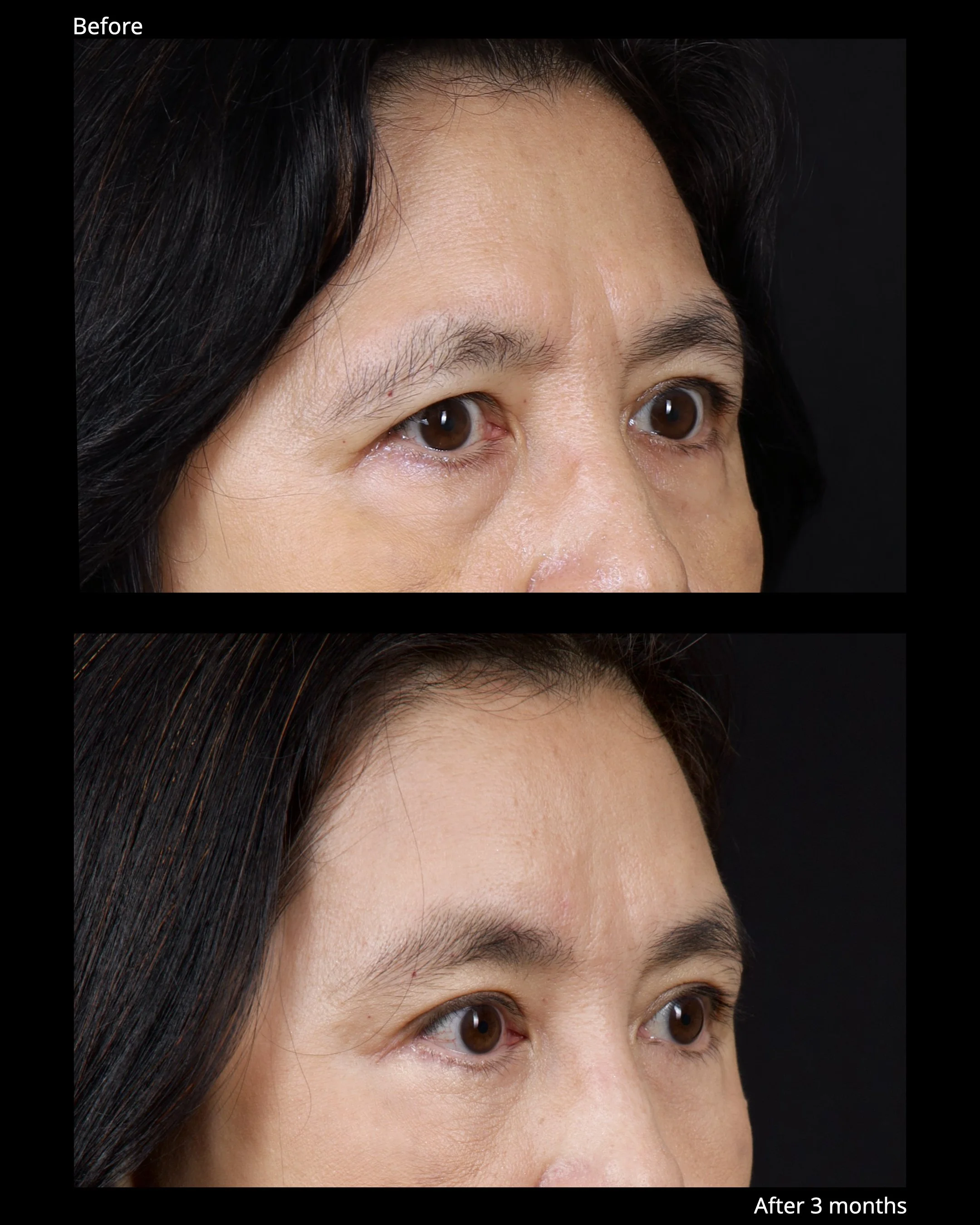 Before and after endoscopic brow lift showing improved eyebrow position and brighter upper eyelid appearance.