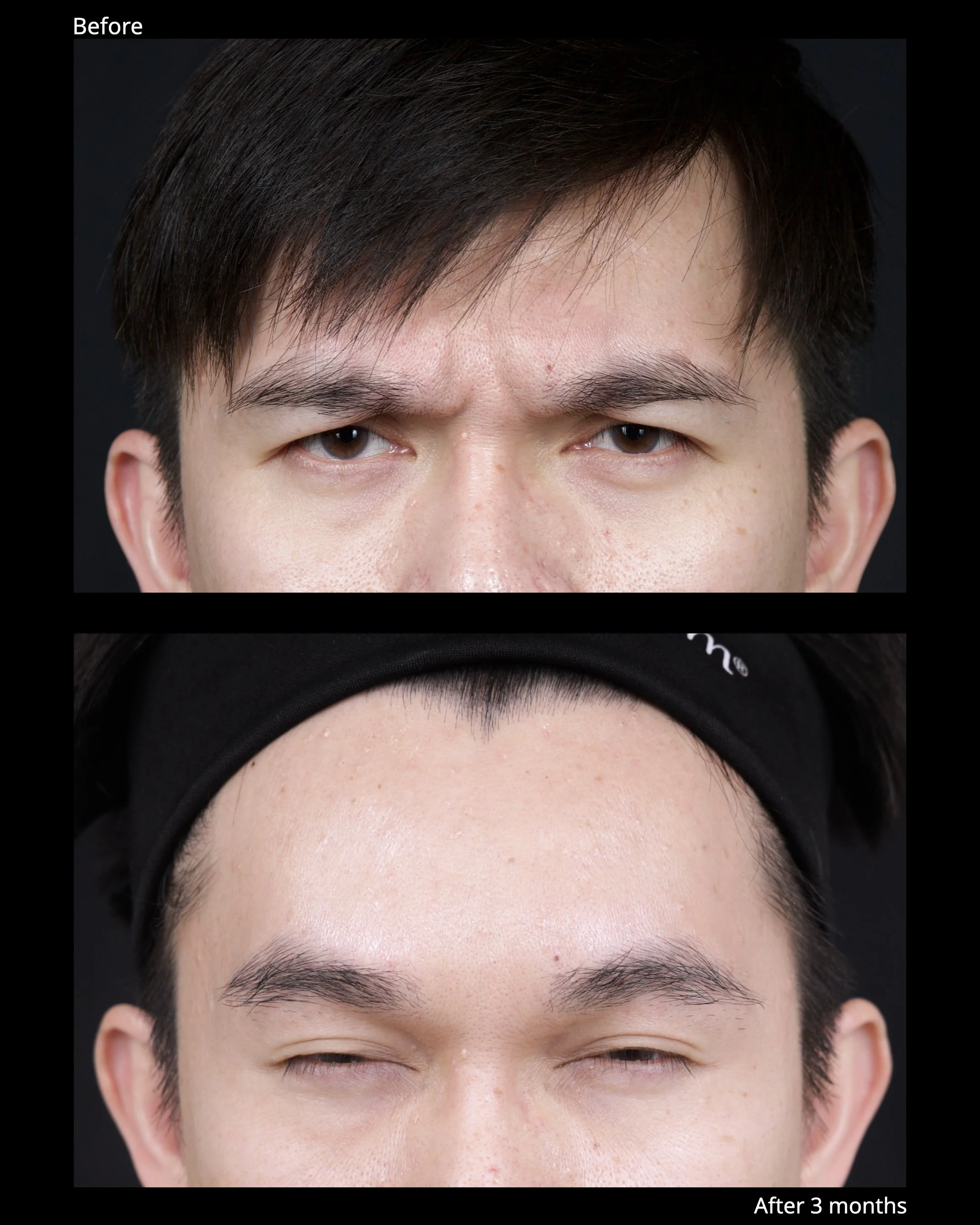 Before and after endoscopic brow lift showing improved eyebrow position and brighter upper eyelid appearance.