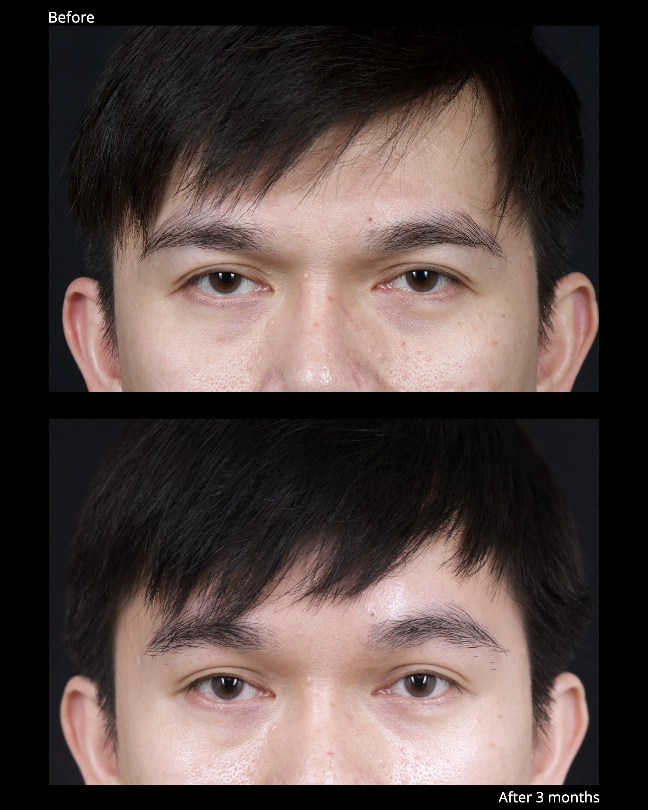 Before and after endoscopic brow lift showing improved eyebrow position and brighter upper eyelid appearance.