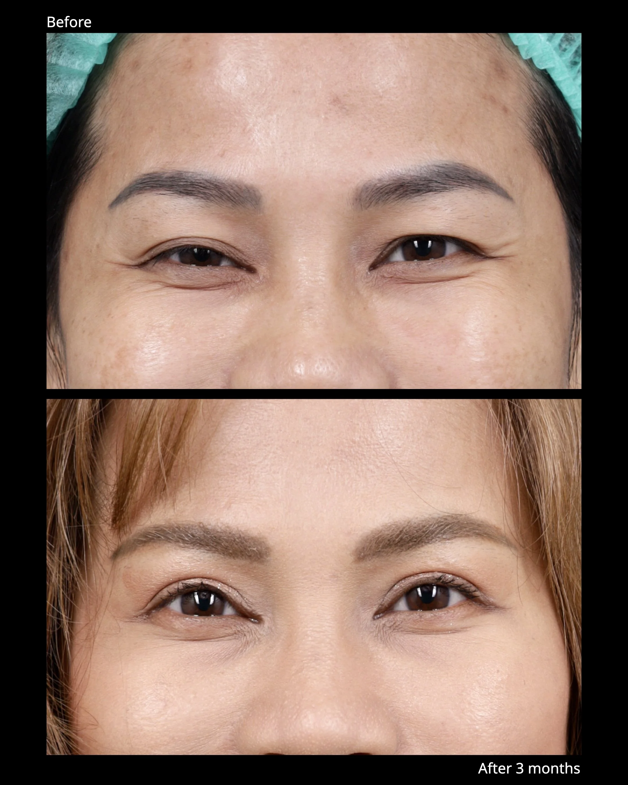 Before and after levator advancement for upper eyelid ptosis, demonstrating improved eyelid elevation and symmetry.