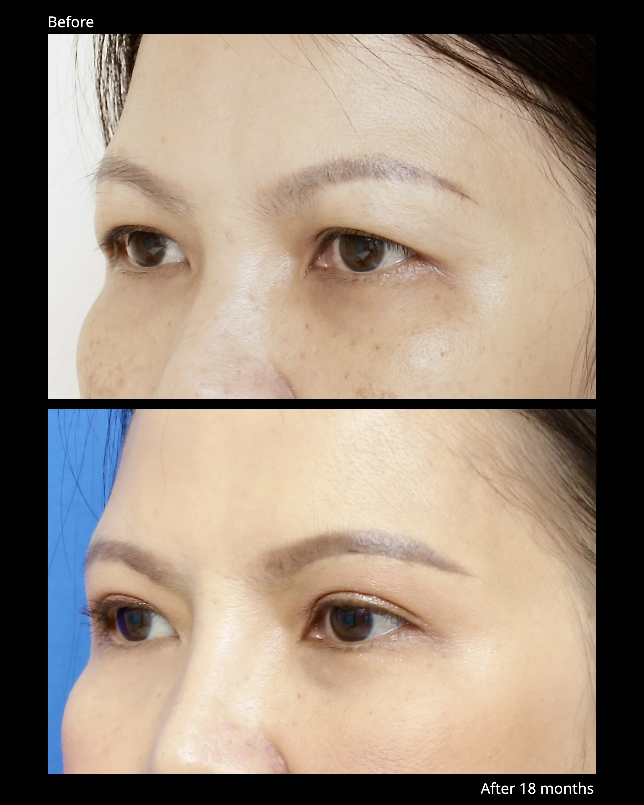 Sub Brow Lift Before and After