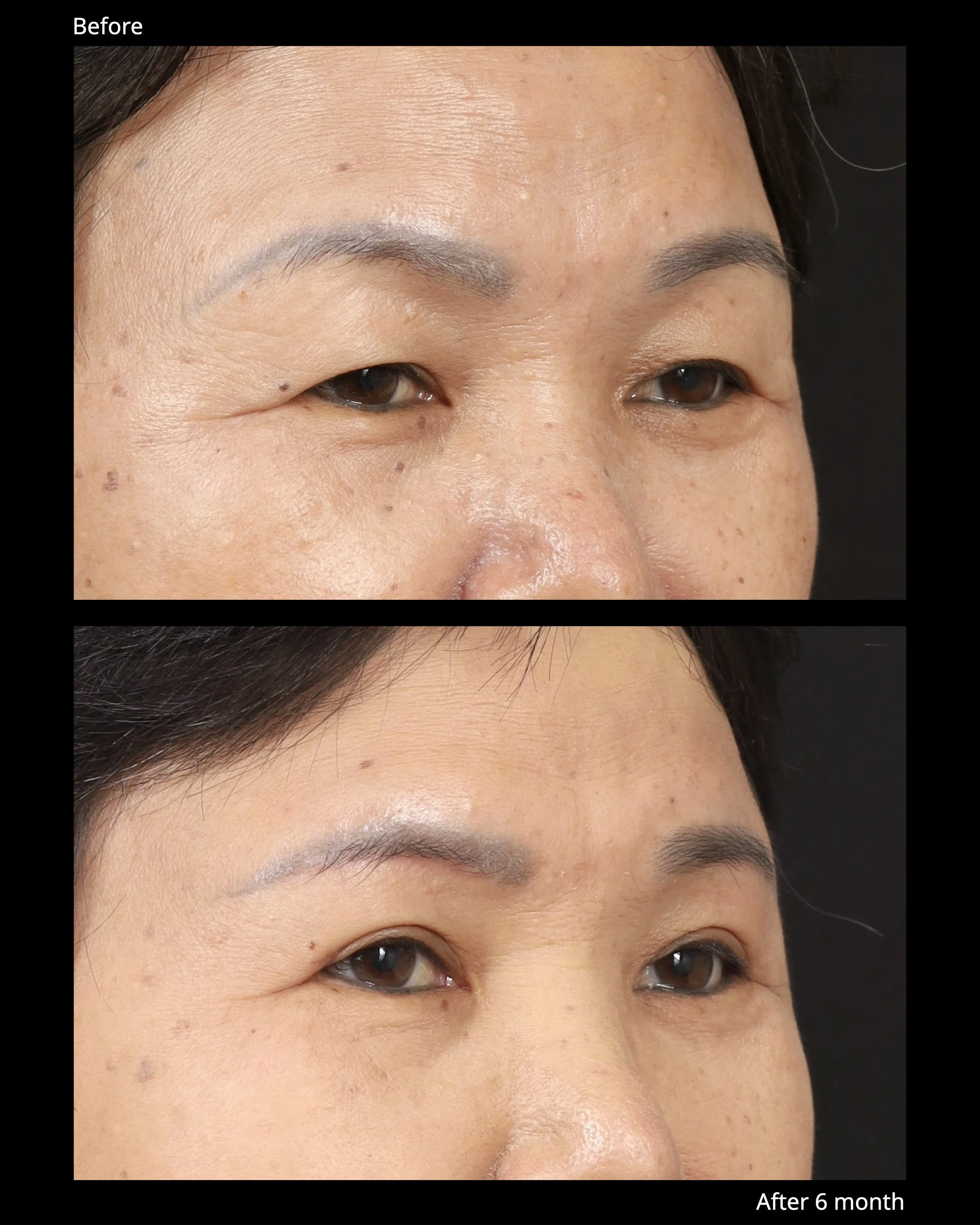 Sub Brow Lift Before and After