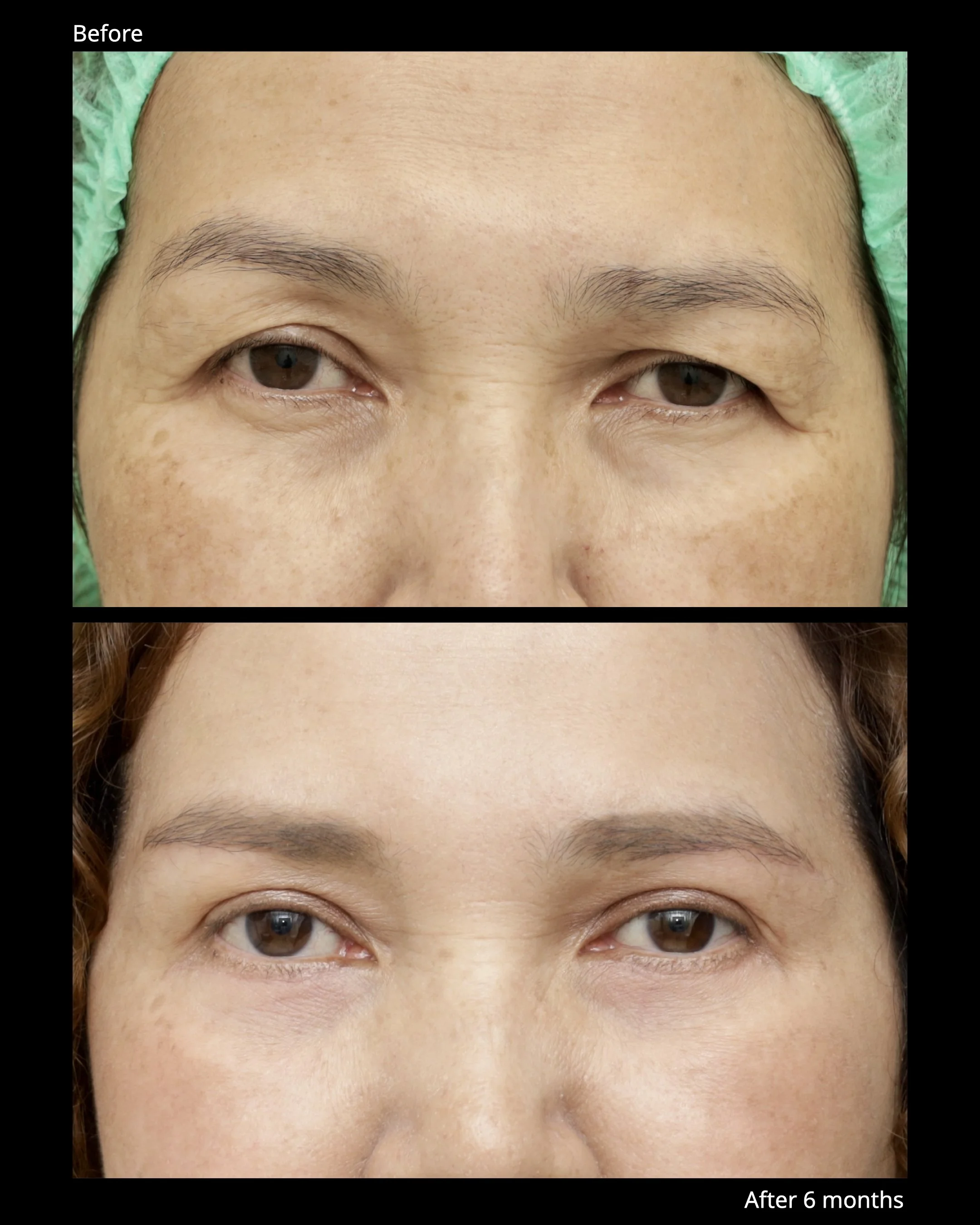 Sub Brow Lift Before and After