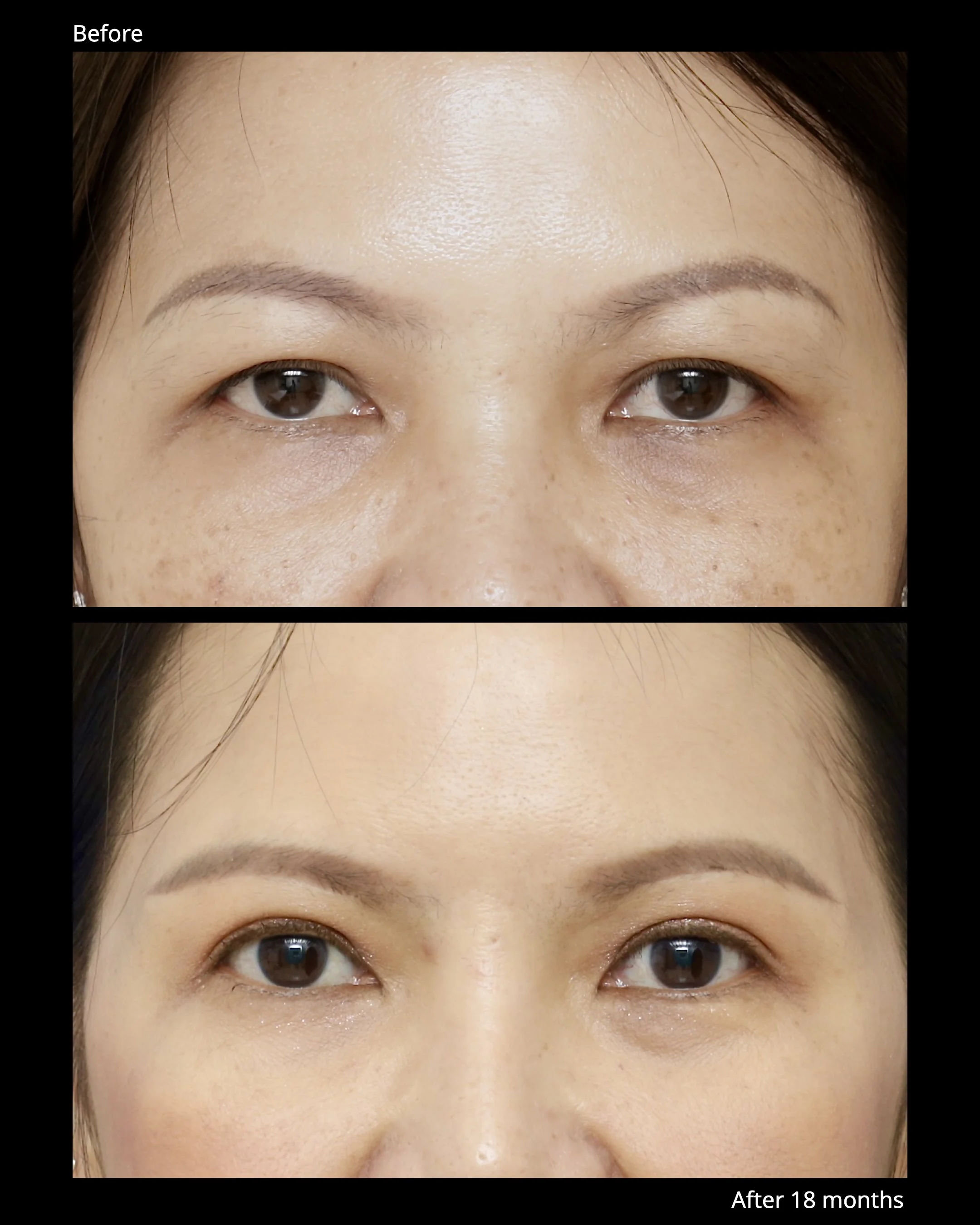 Sub Brow Lift Before and After