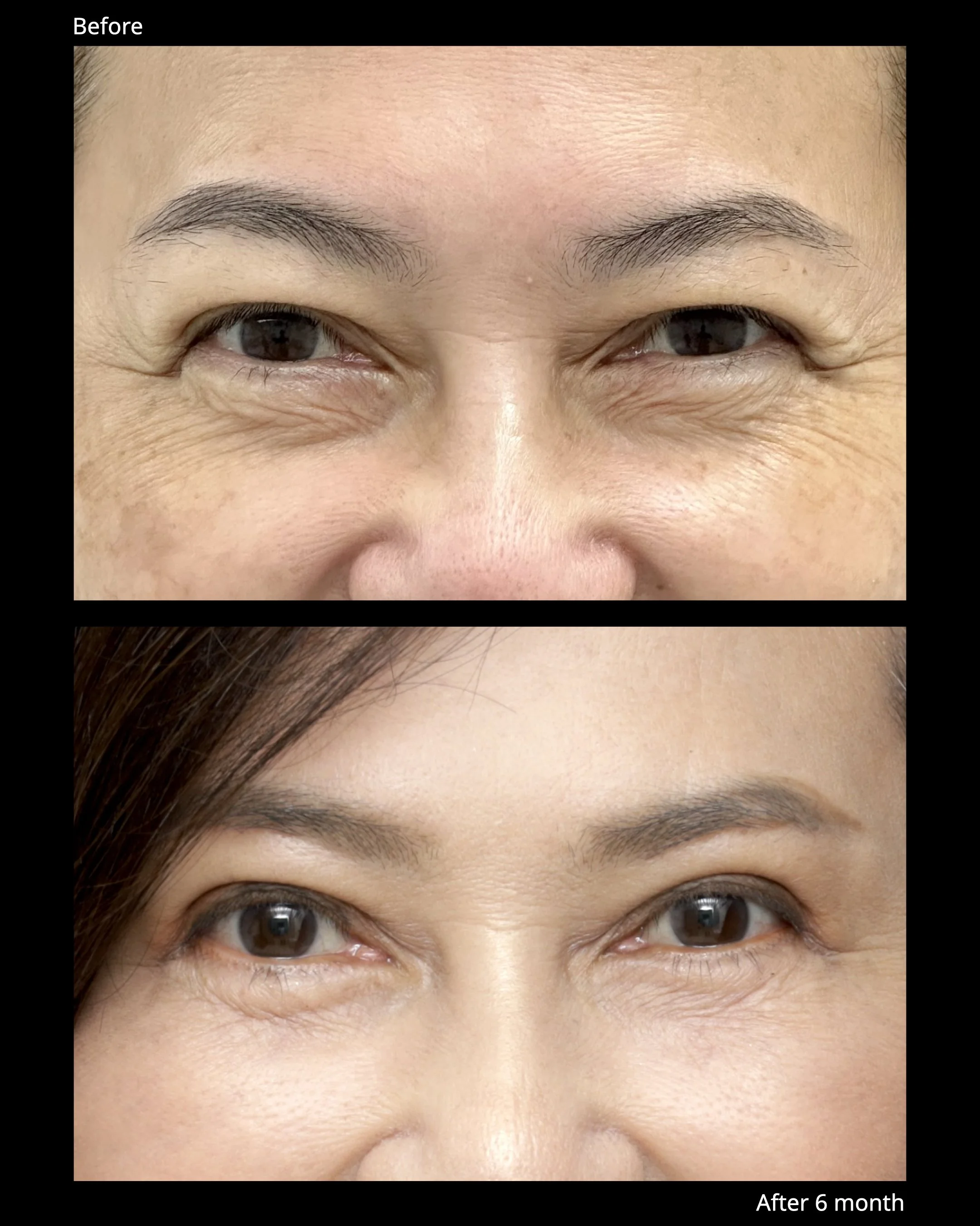 Sub Brow Lift Before and After