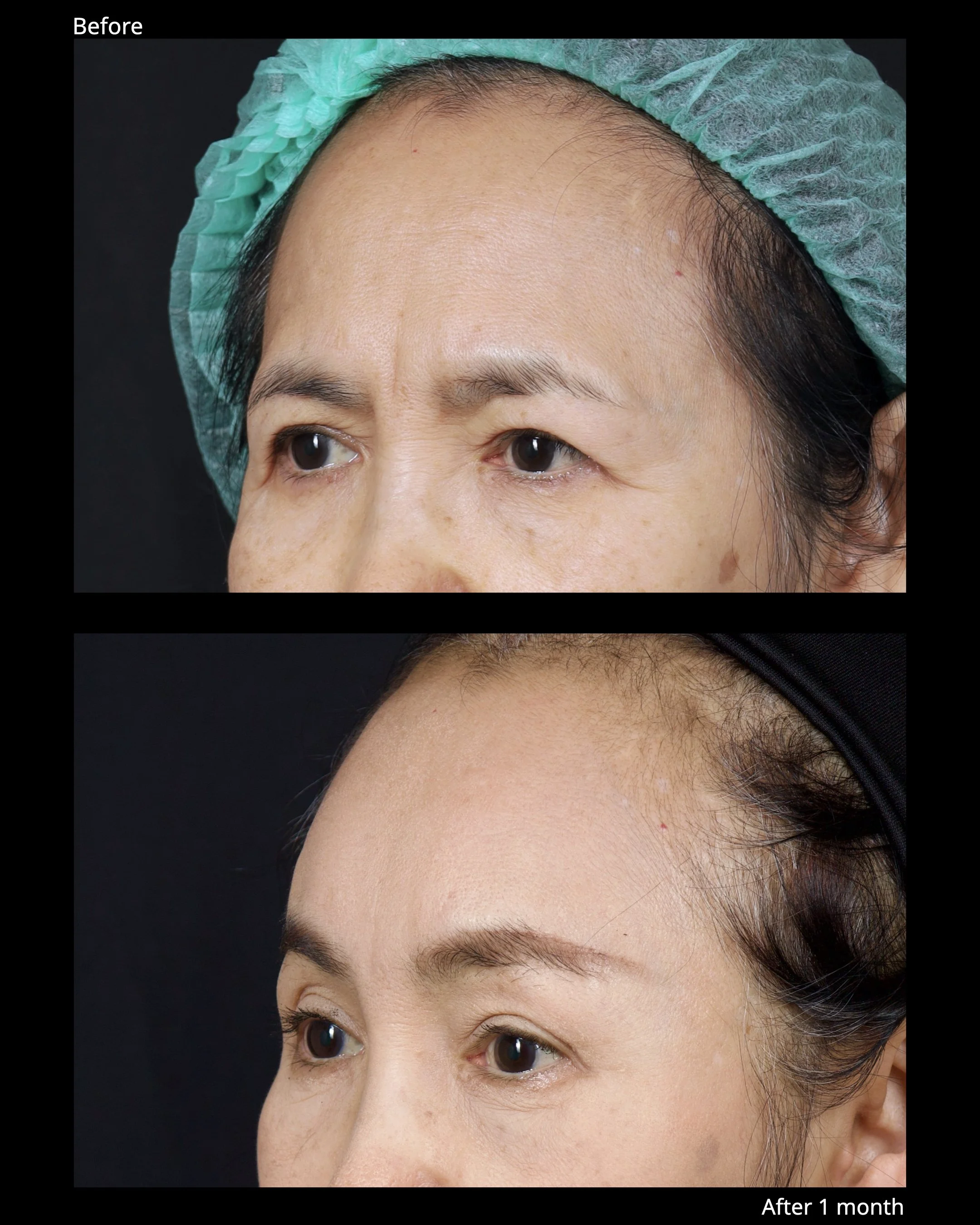 Before and after endoscopic brow lift showing improved eyebrow position and brighter upper eyelid appearance.