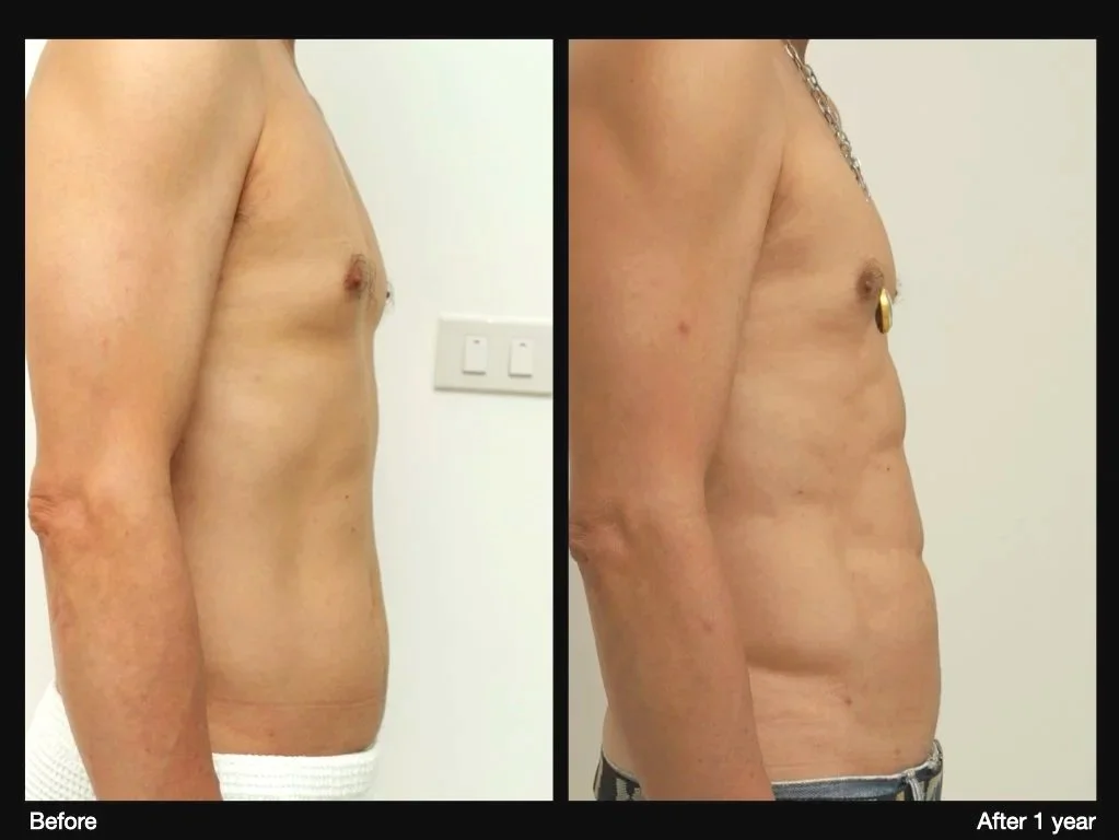 Before and after endoscopic brow lift showing improved eyebrow position and brighter upper eyelid appearance.