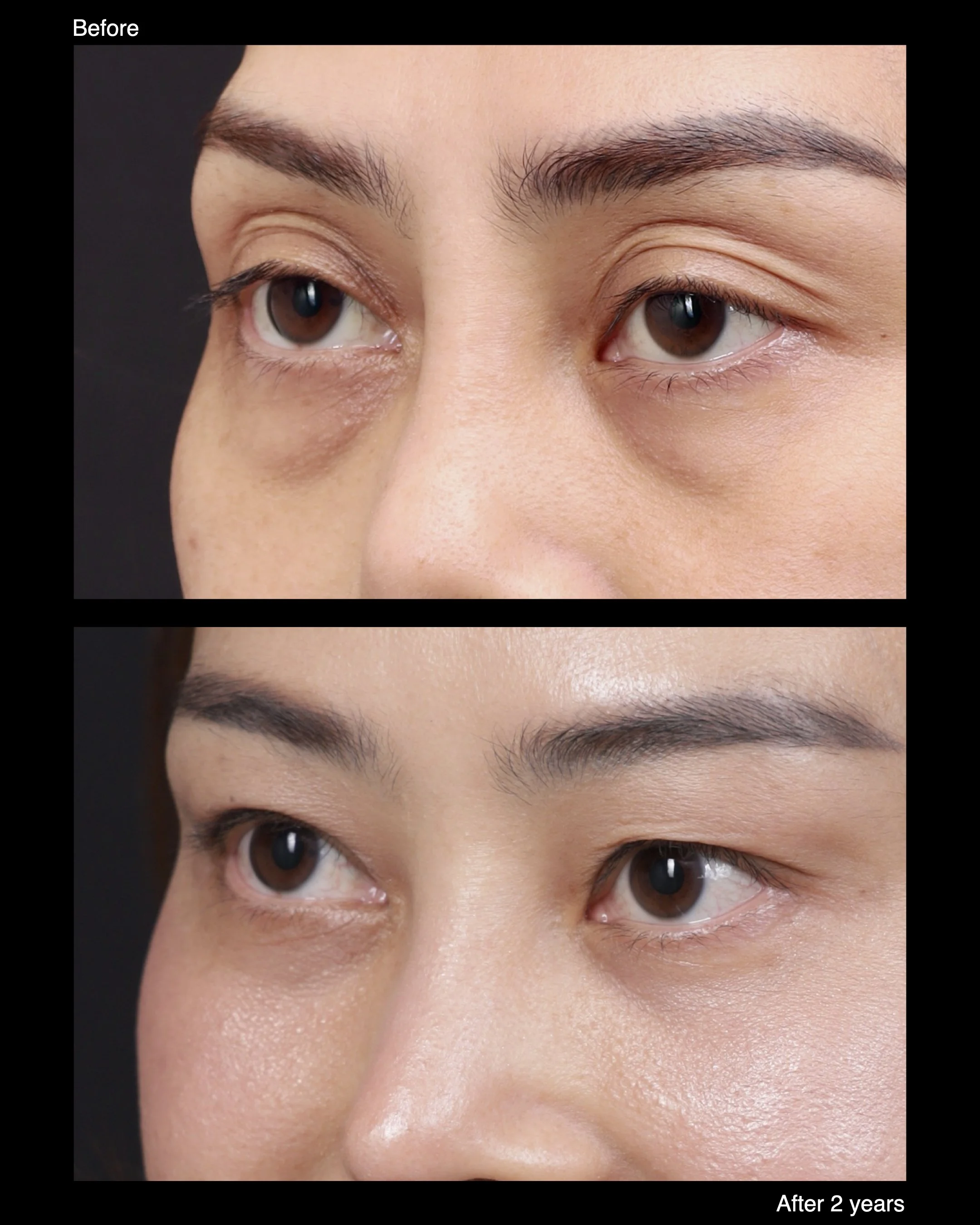 Before and after levator advancement for upper eyelid ptosis, demonstrating improved eyelid elevation and symmetry.