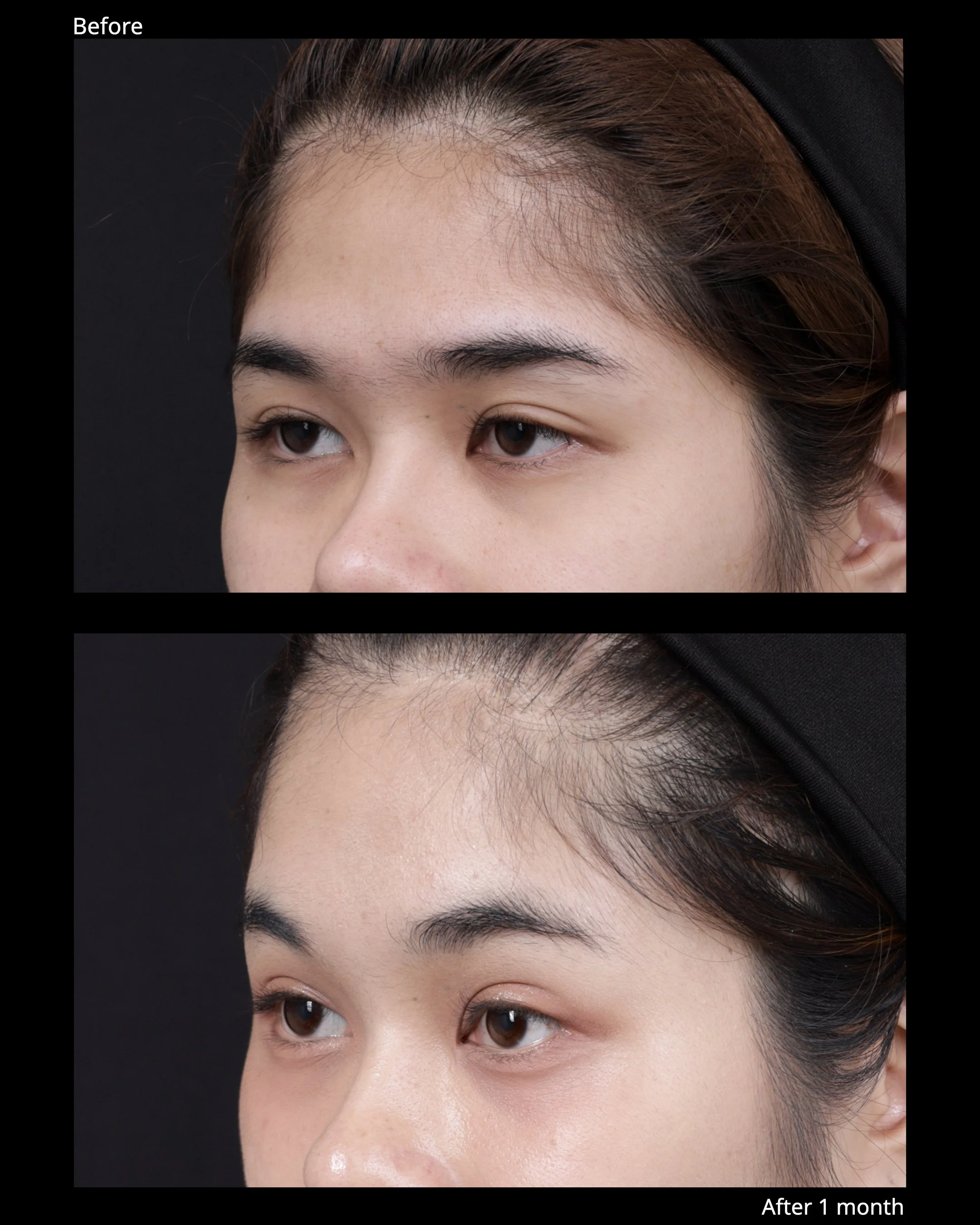 Image 2 Endoscopic brow lift before and after result with natural brow elevation and softer forehead expression.