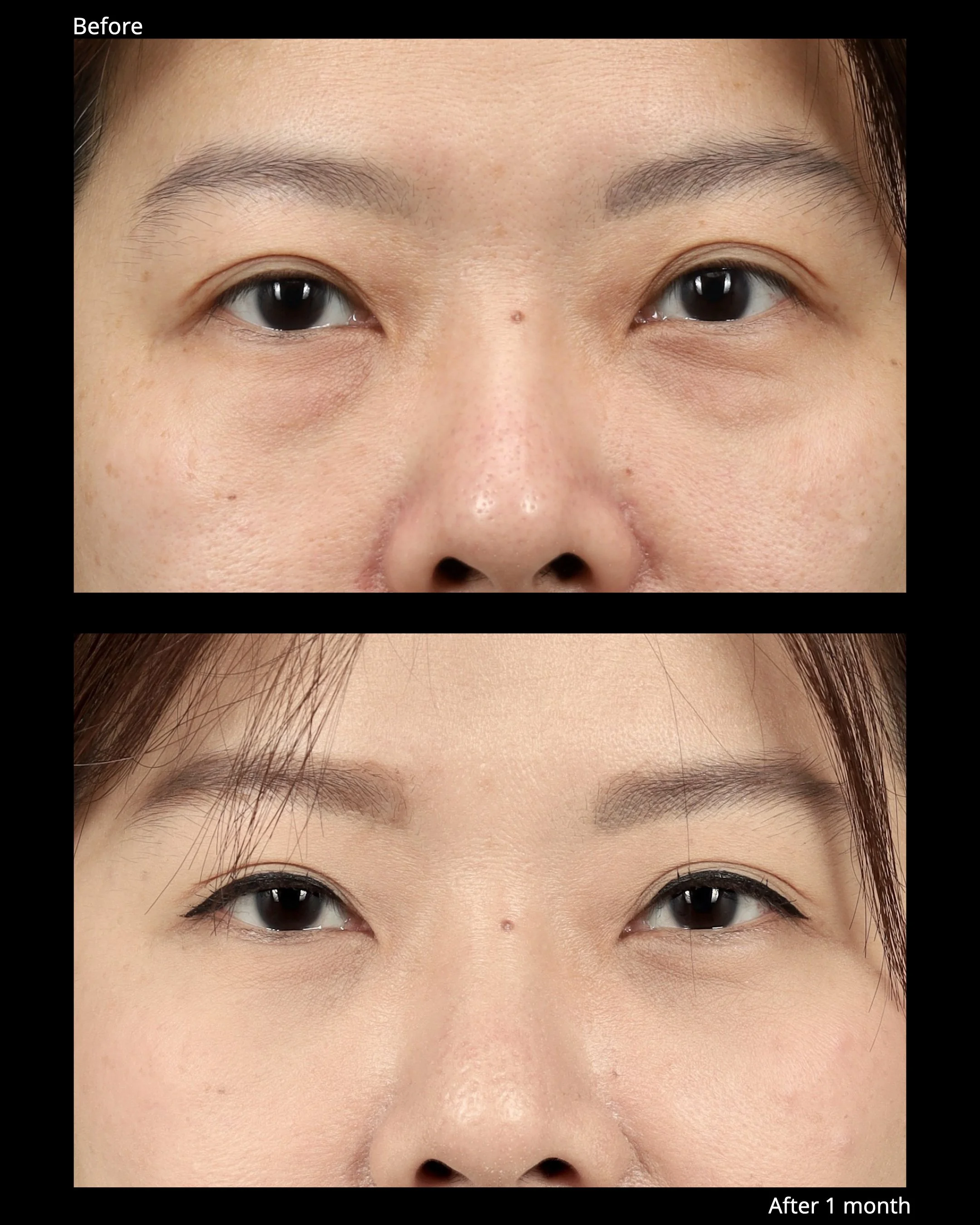 Before and after transconjunctival lower blepharoplasty with for under-eye bags.