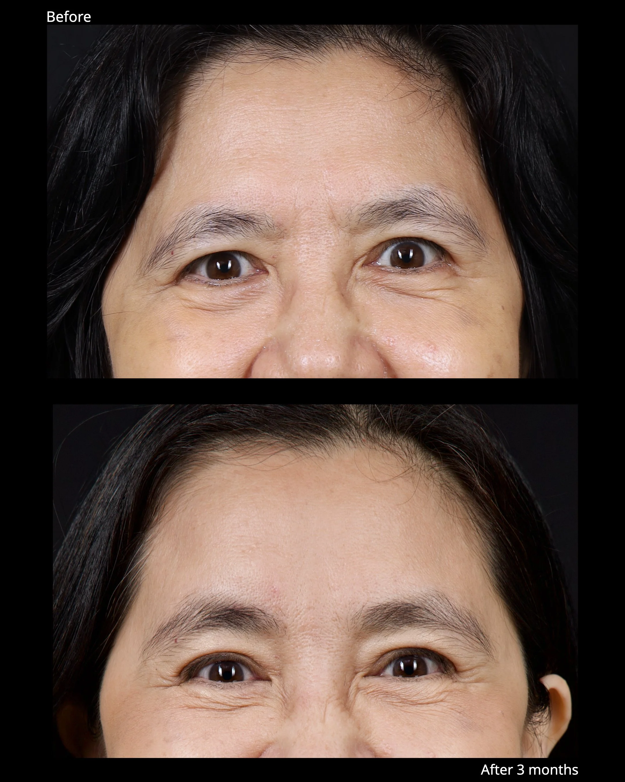 Before and after endoscopic brow lift showing improved eyebrow position and brighter upper eyelid appearance.