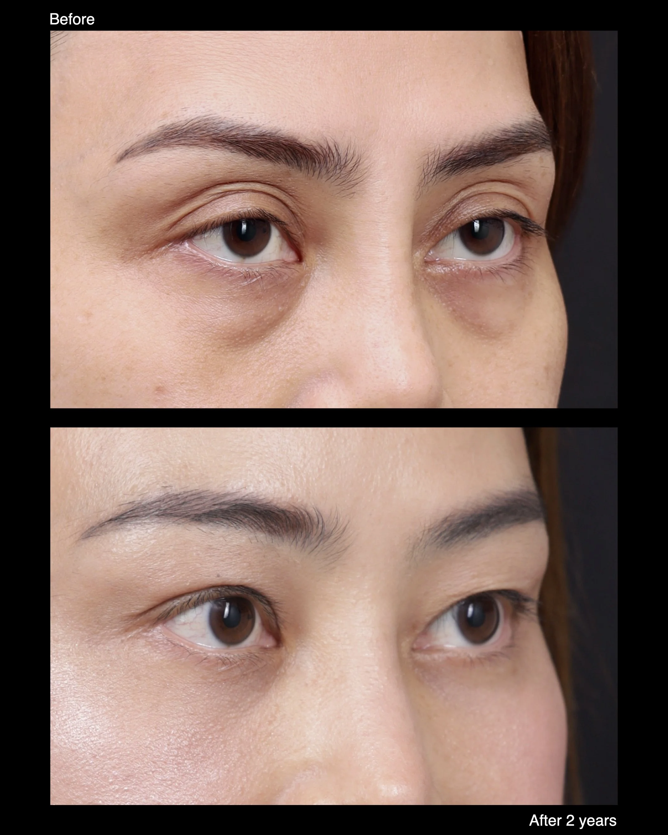 Before and after levator advancement for upper eyelid ptosis, demonstrating improved eyelid elevation and symmetry.