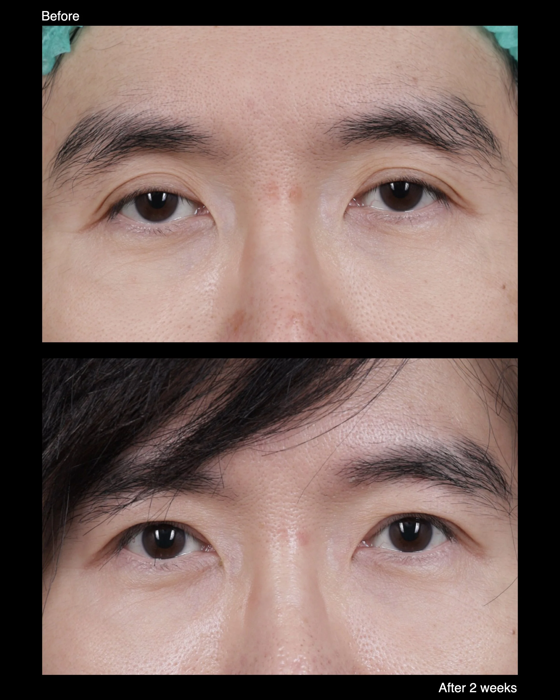 Before and after ptosis correction with levator advancement, showing improved upper eyelid height and more balanced eye opening.