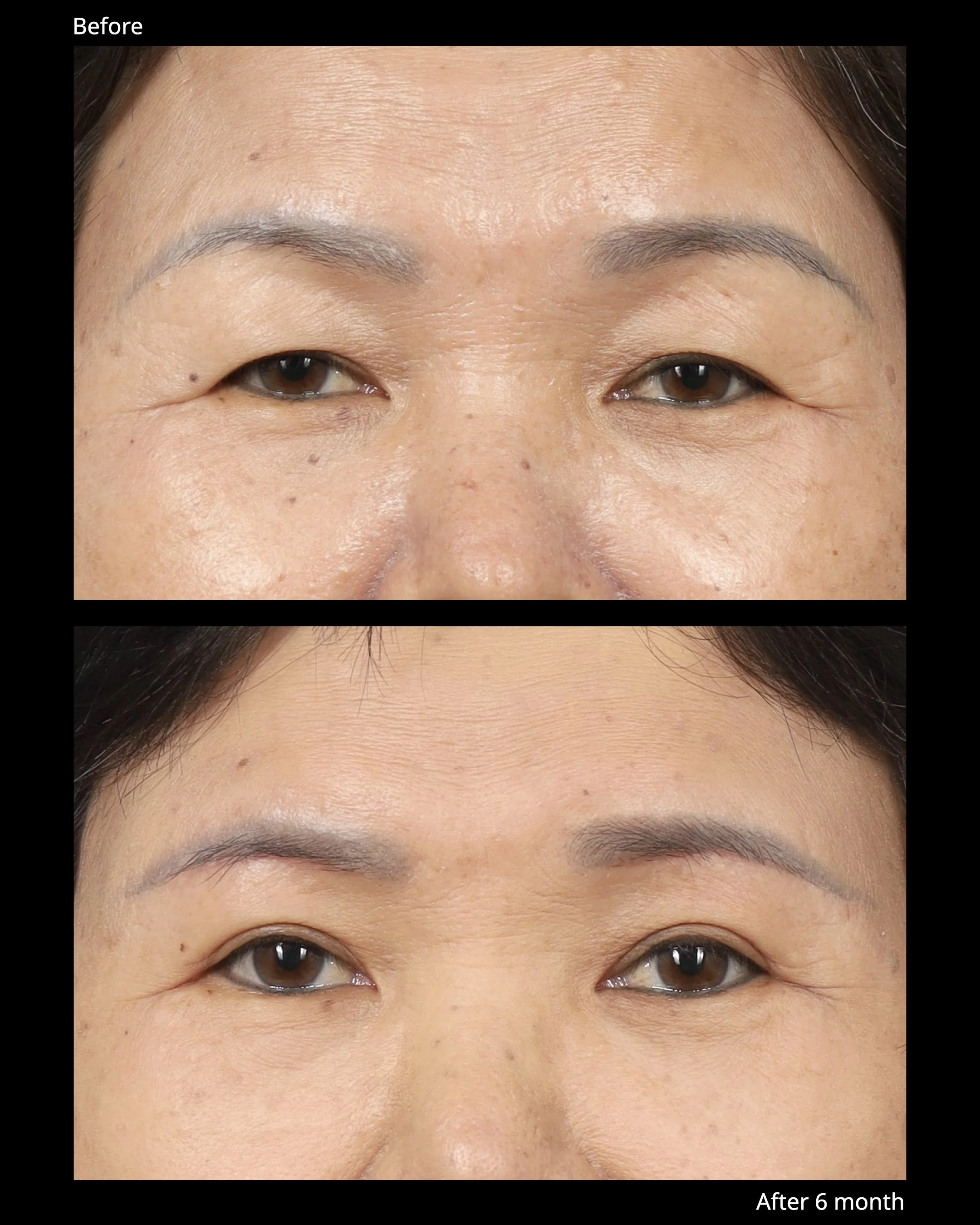 Sub Brow Lift Before and After