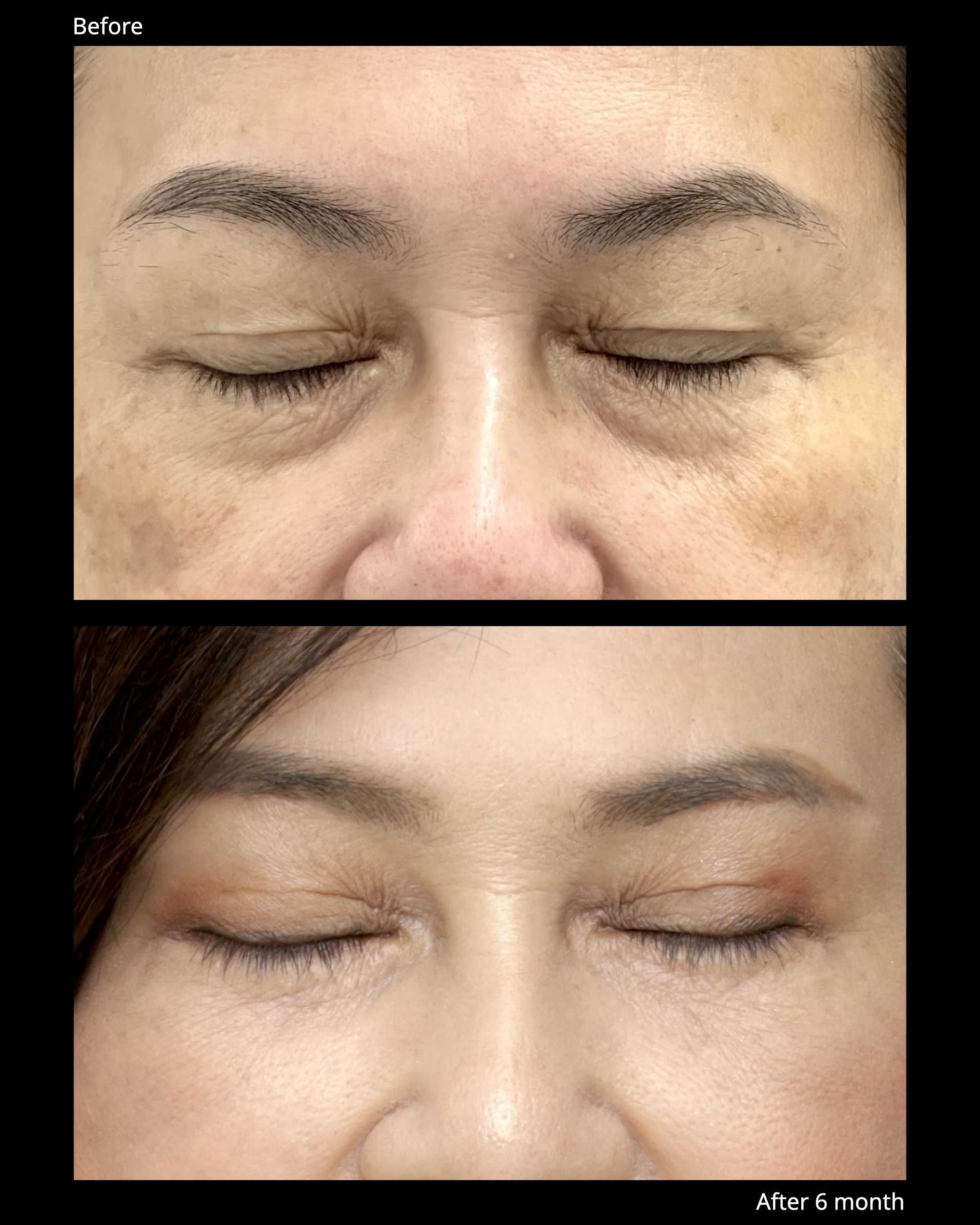 Sub Brow Lift Before and After