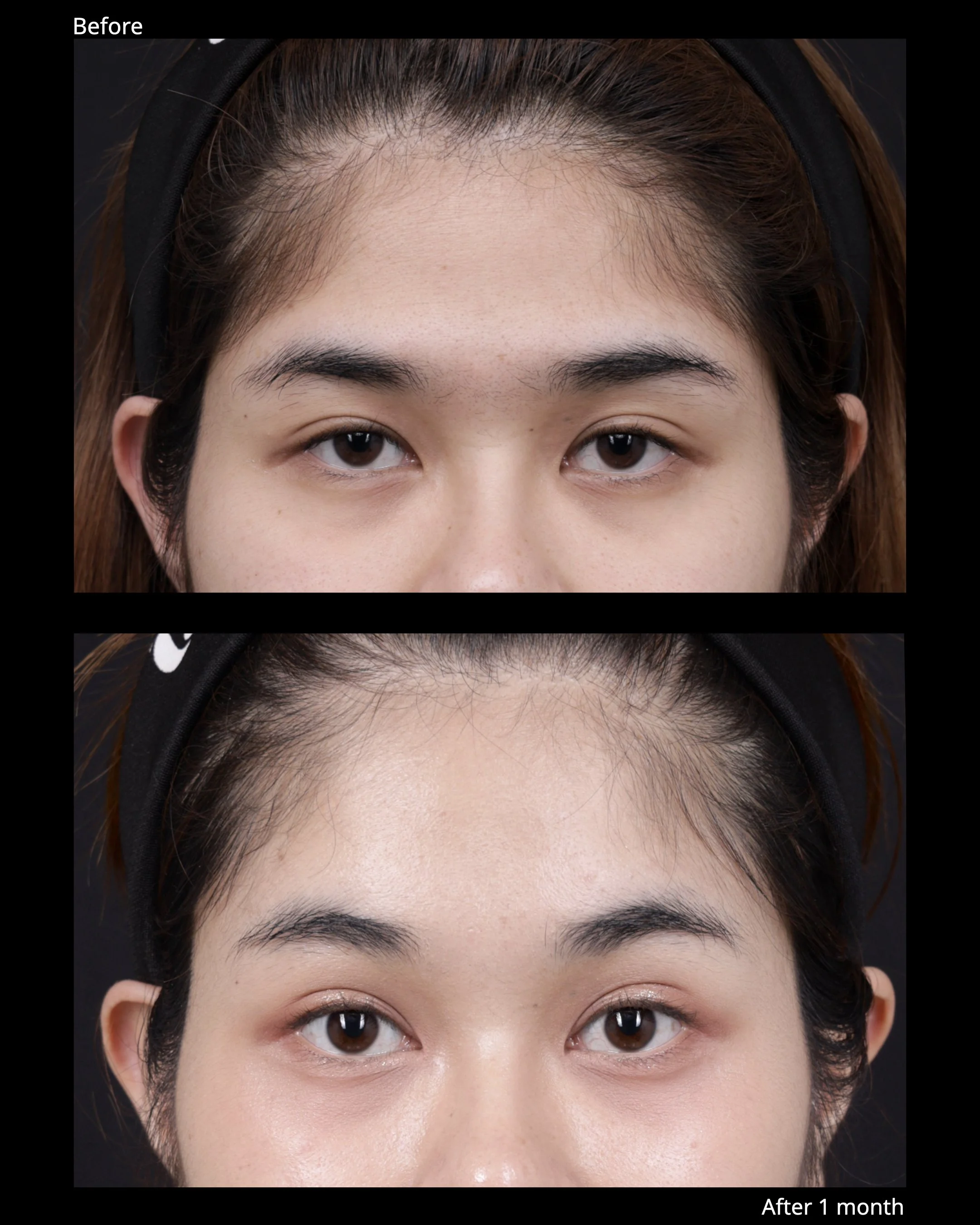 Image 2 Endoscopic brow lift before and after result with natural brow elevation and softer forehead expression.