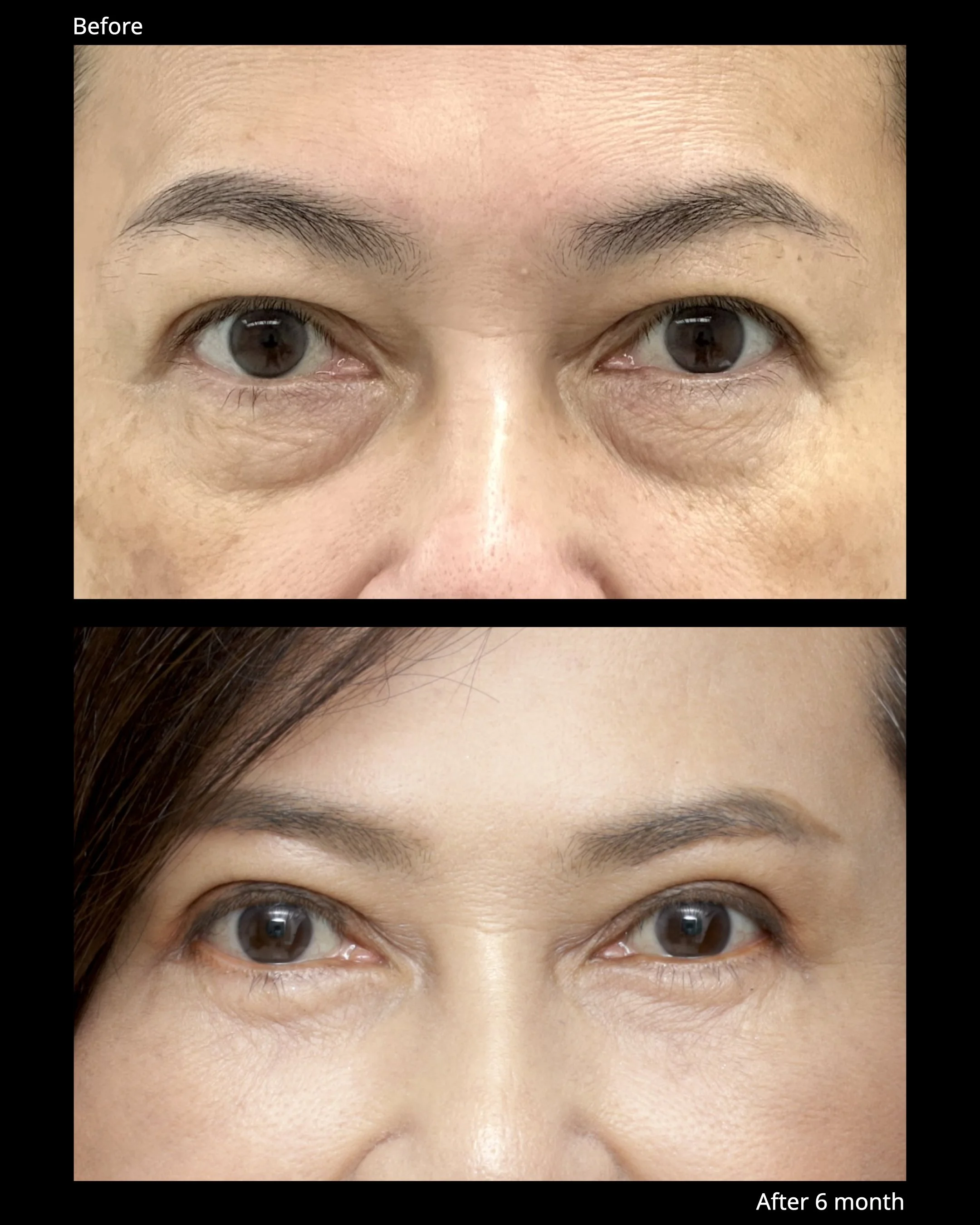 Sub Brow Lift Before and After