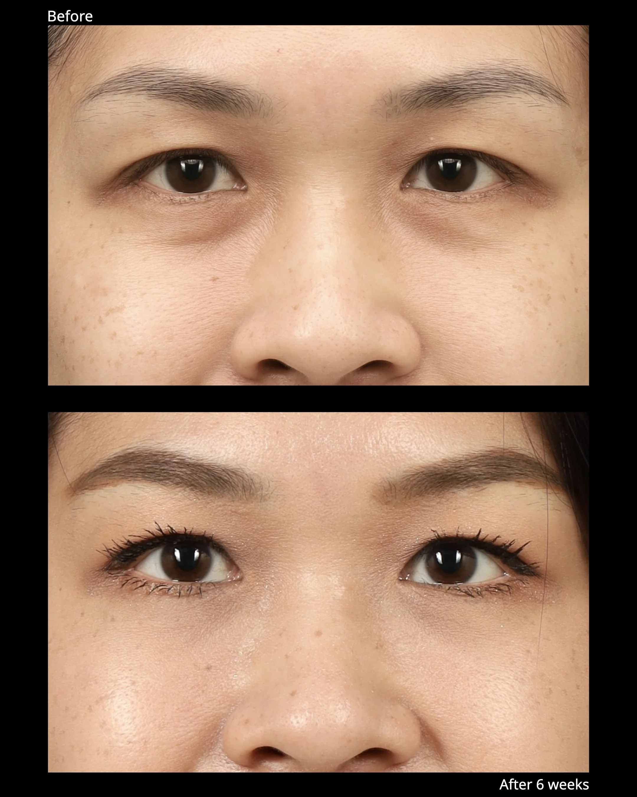 Before and after lower eyelid rejuvenation showing improvement of under-eye bags and tear trough shadow.