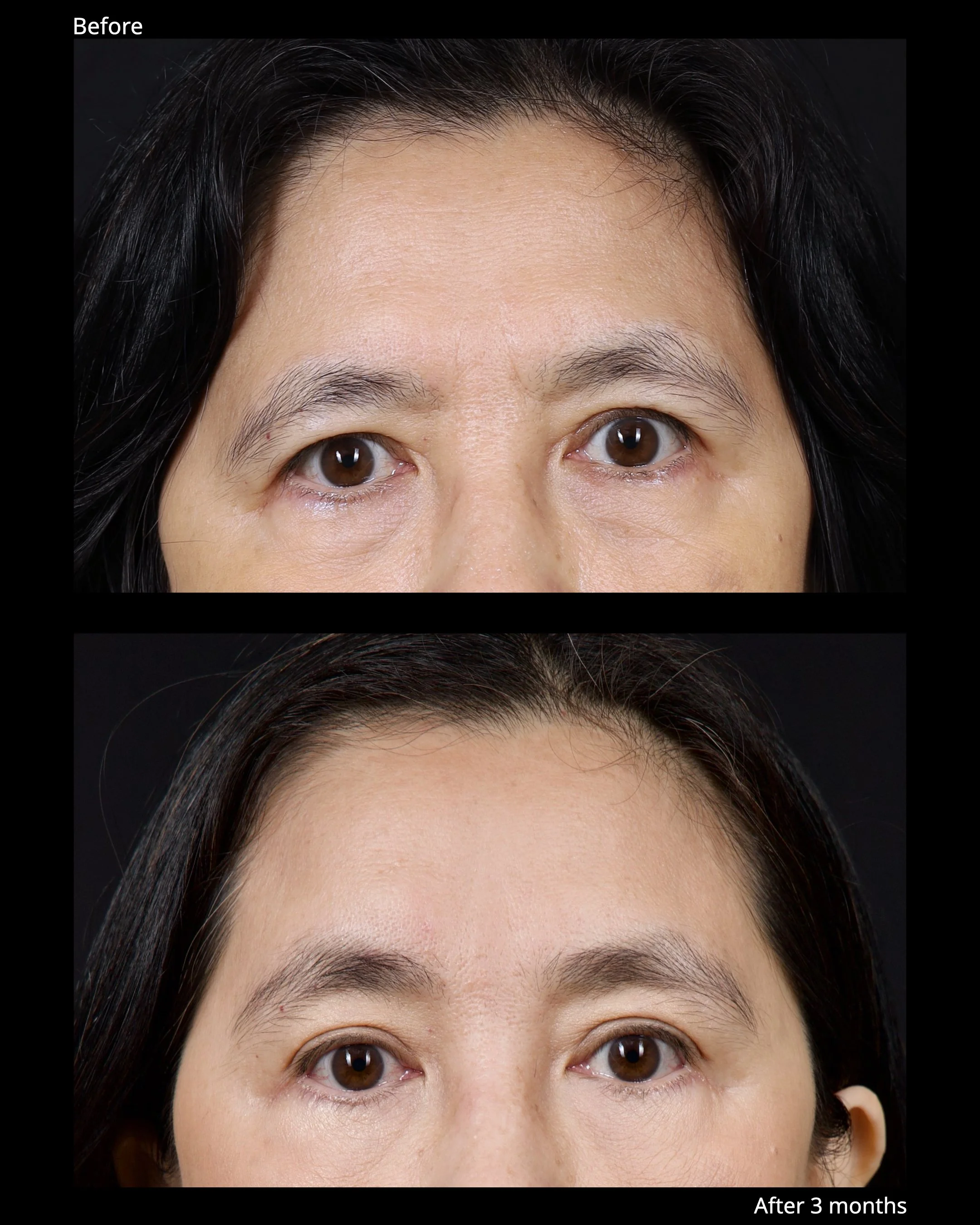 Before and after endoscopic brow lift showing improved eyebrow position and brighter upper eyelid appearance.