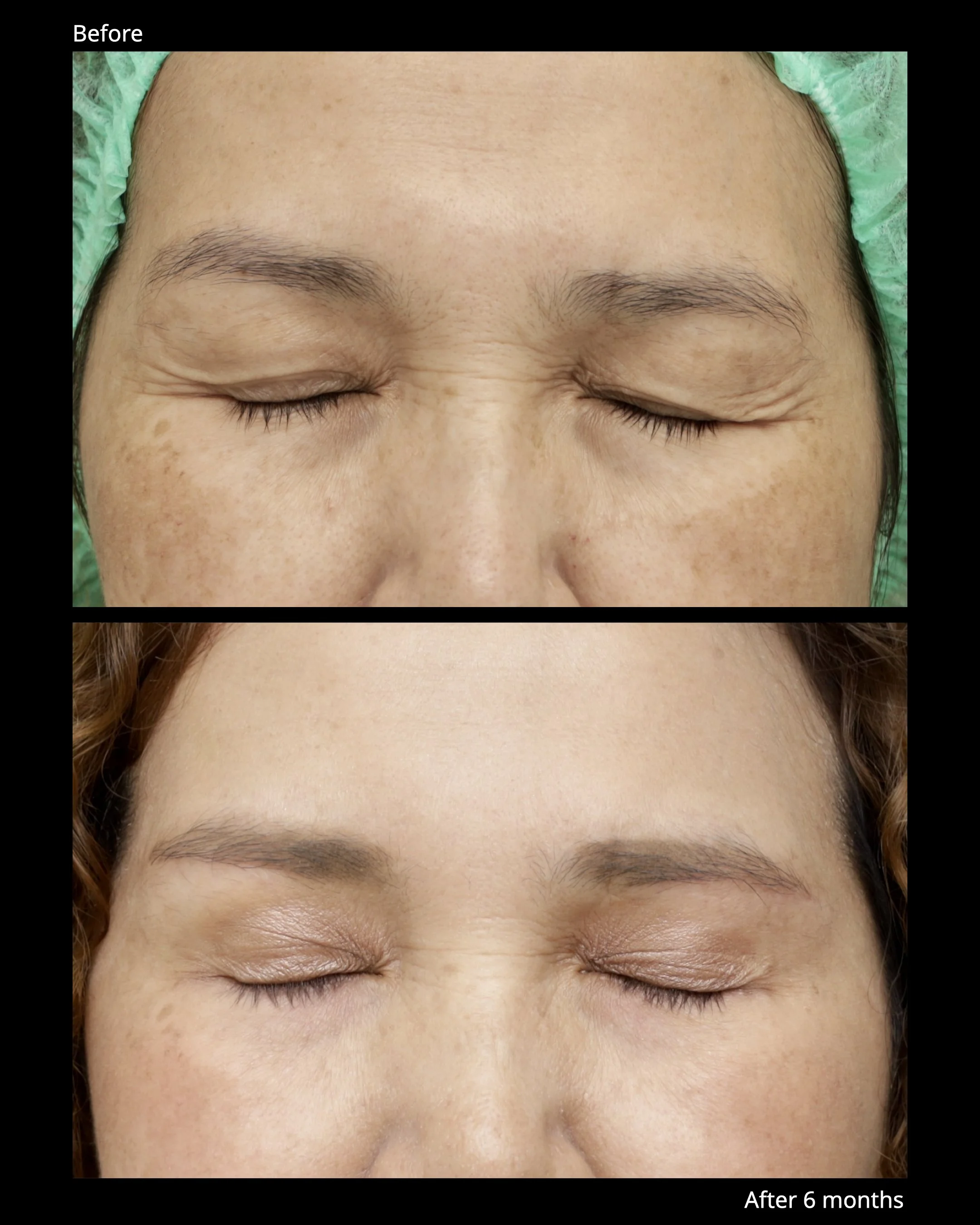 Sub Brow Lift Before and After