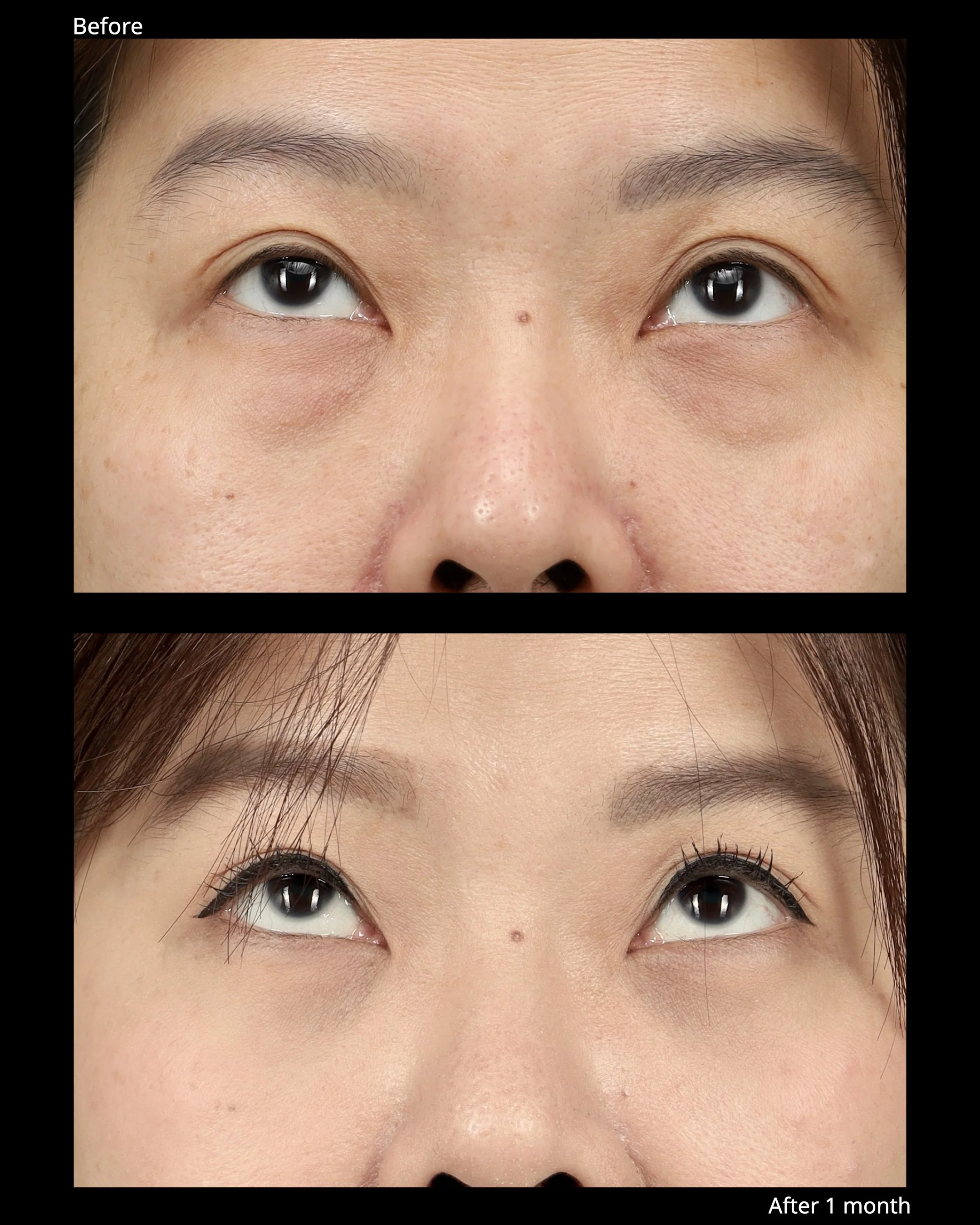 Before and after transconjunctival lower blepharoplasty with for under-eye bags.