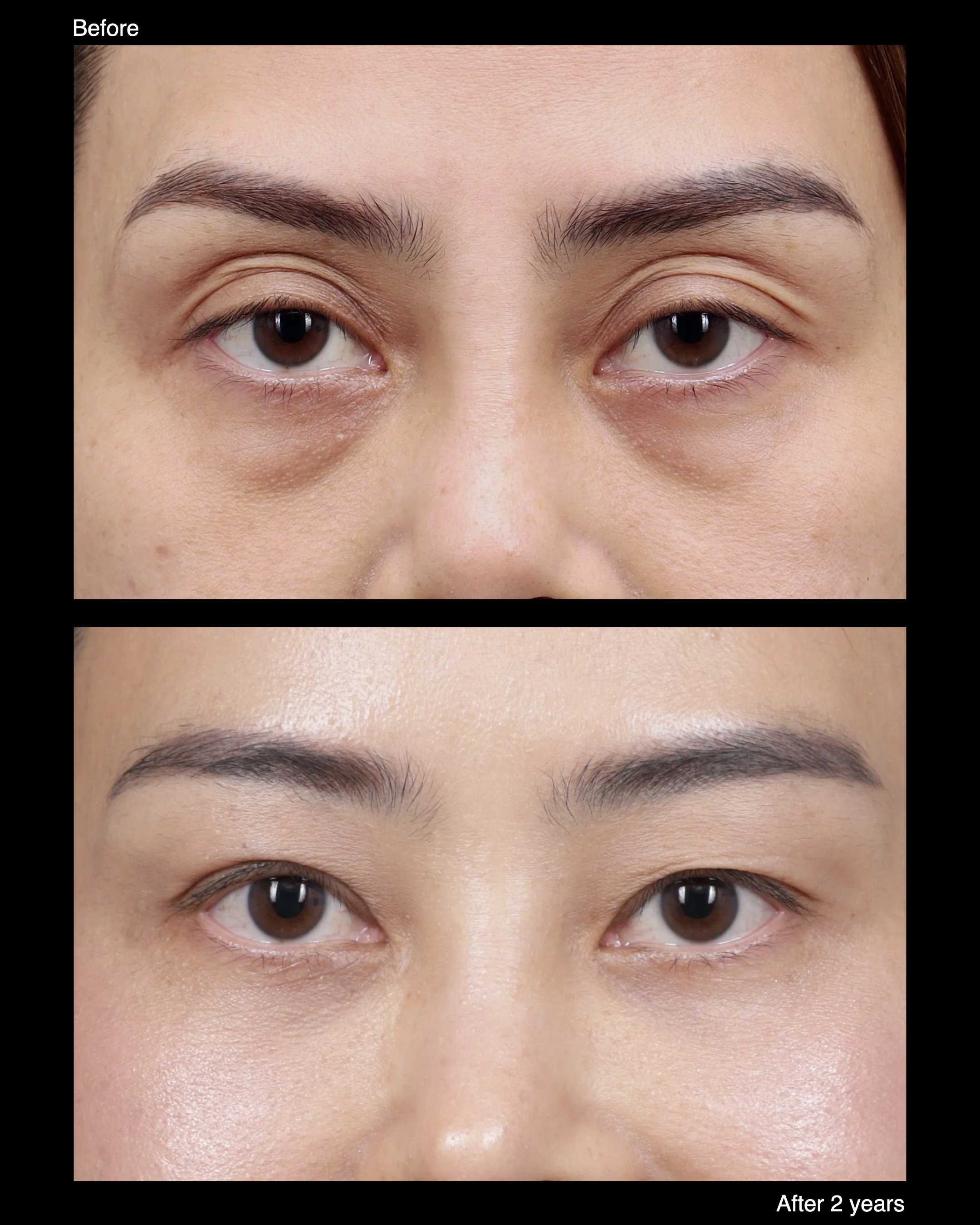 Before and after levator advancement for upper eyelid ptosis, demonstrating improved eyelid elevation and symmetry.