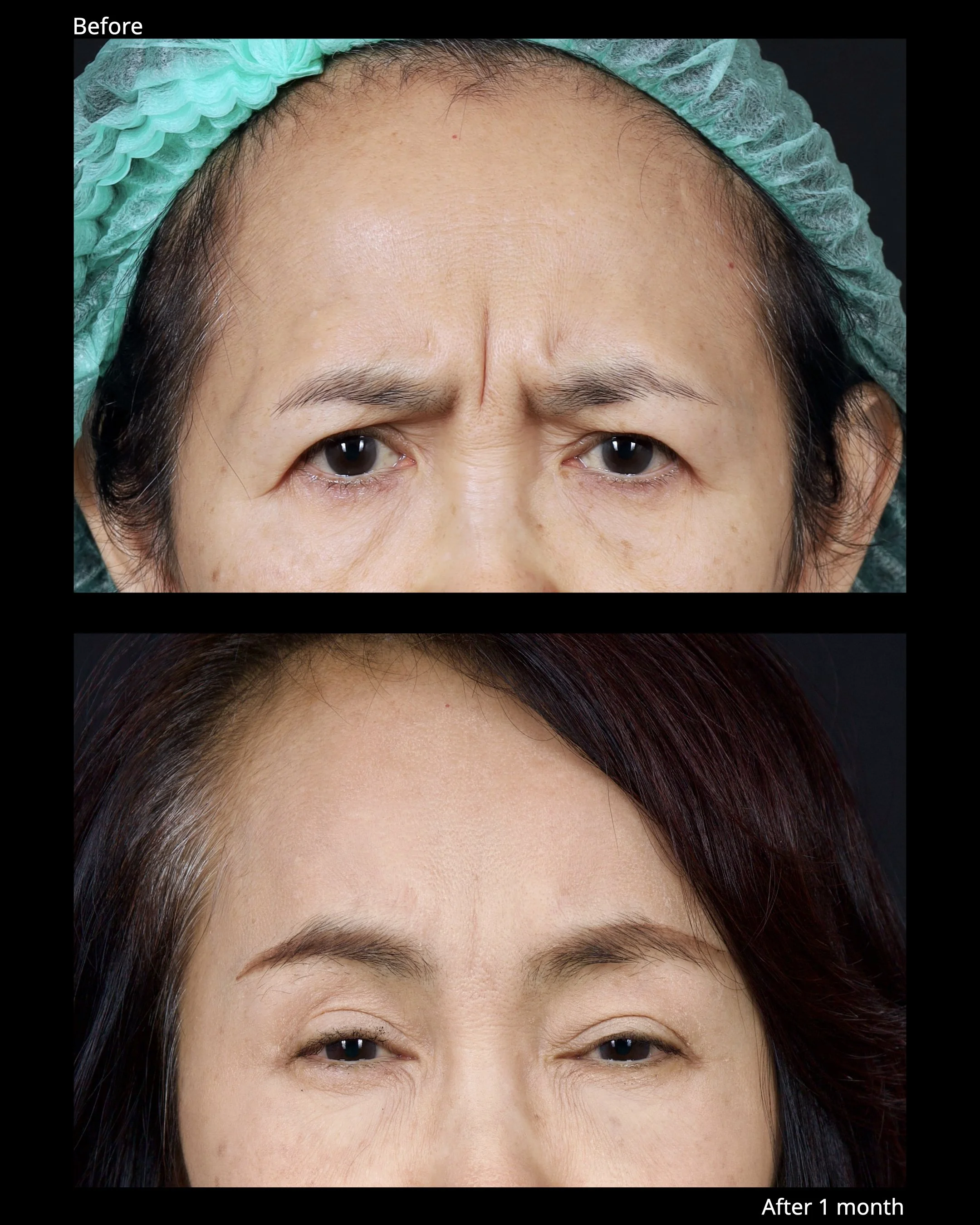 Before and after endoscopic brow lift showing improved eyebrow position and brighter upper eyelid appearance.