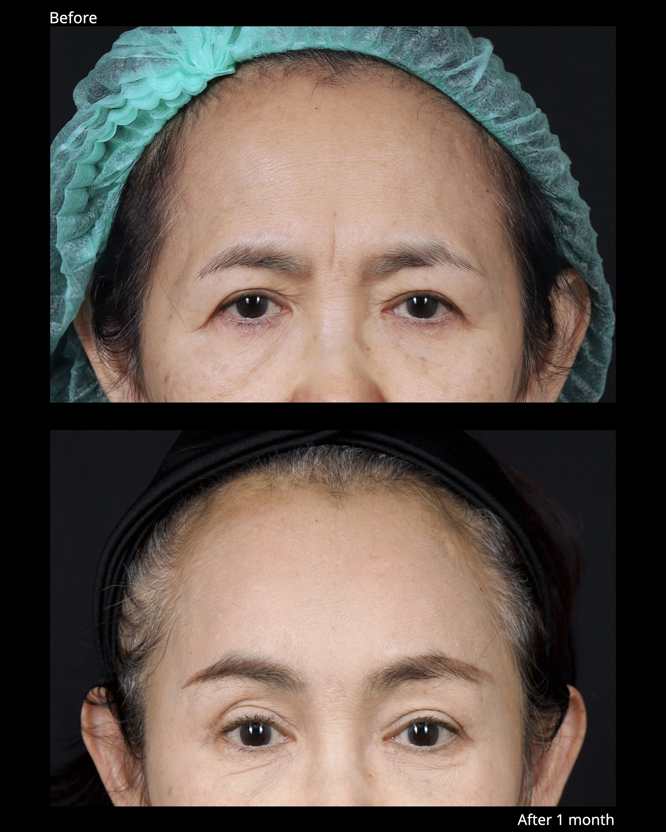 Before and after endoscopic brow lift showing improved eyebrow position and brighter upper eyelid appearance.